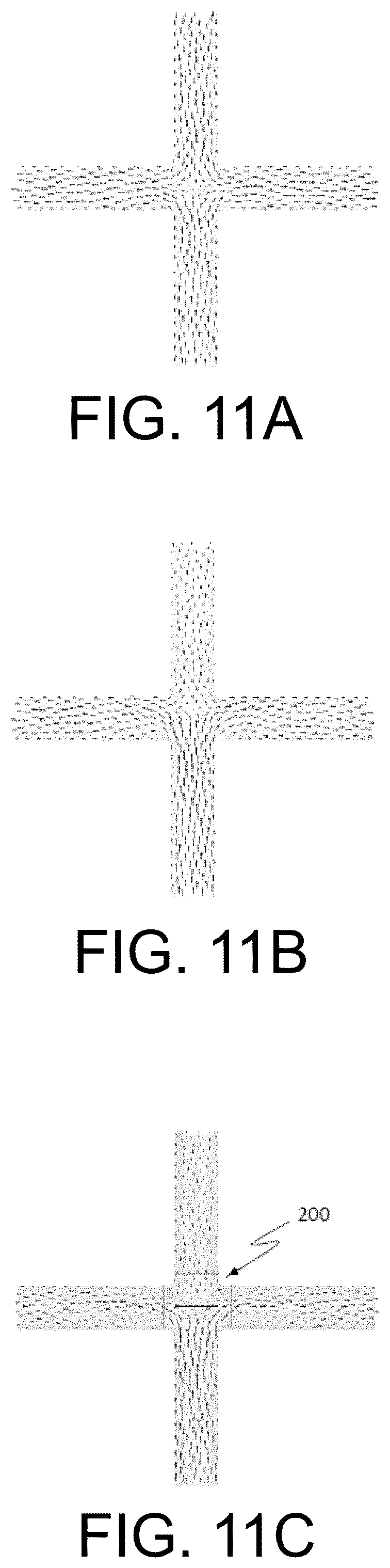 Patent US12472345 Figure 11 – Pulmonary circulation assist implant for a univentricular heart