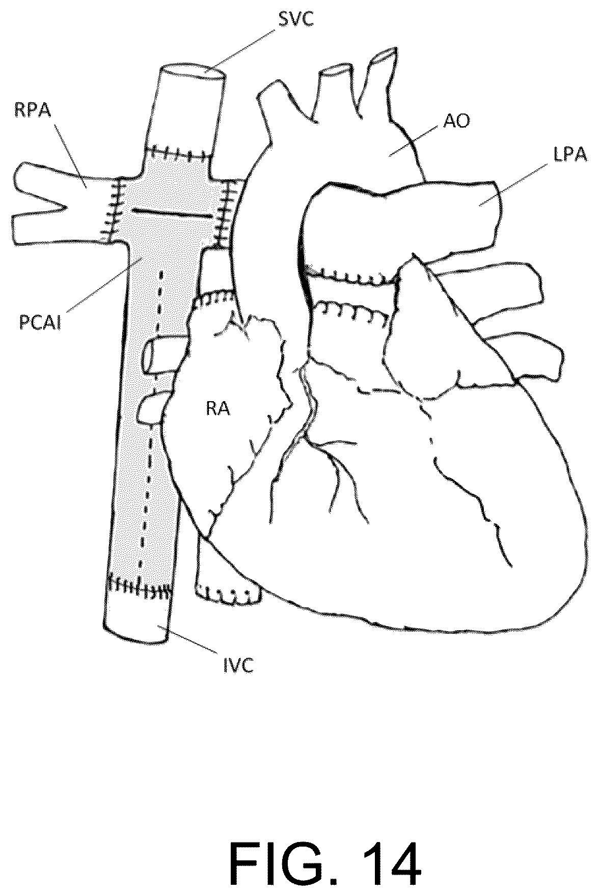 Patent US12472345 Figure 14 – Pulmonary circulation assist implant for a univentricular heart