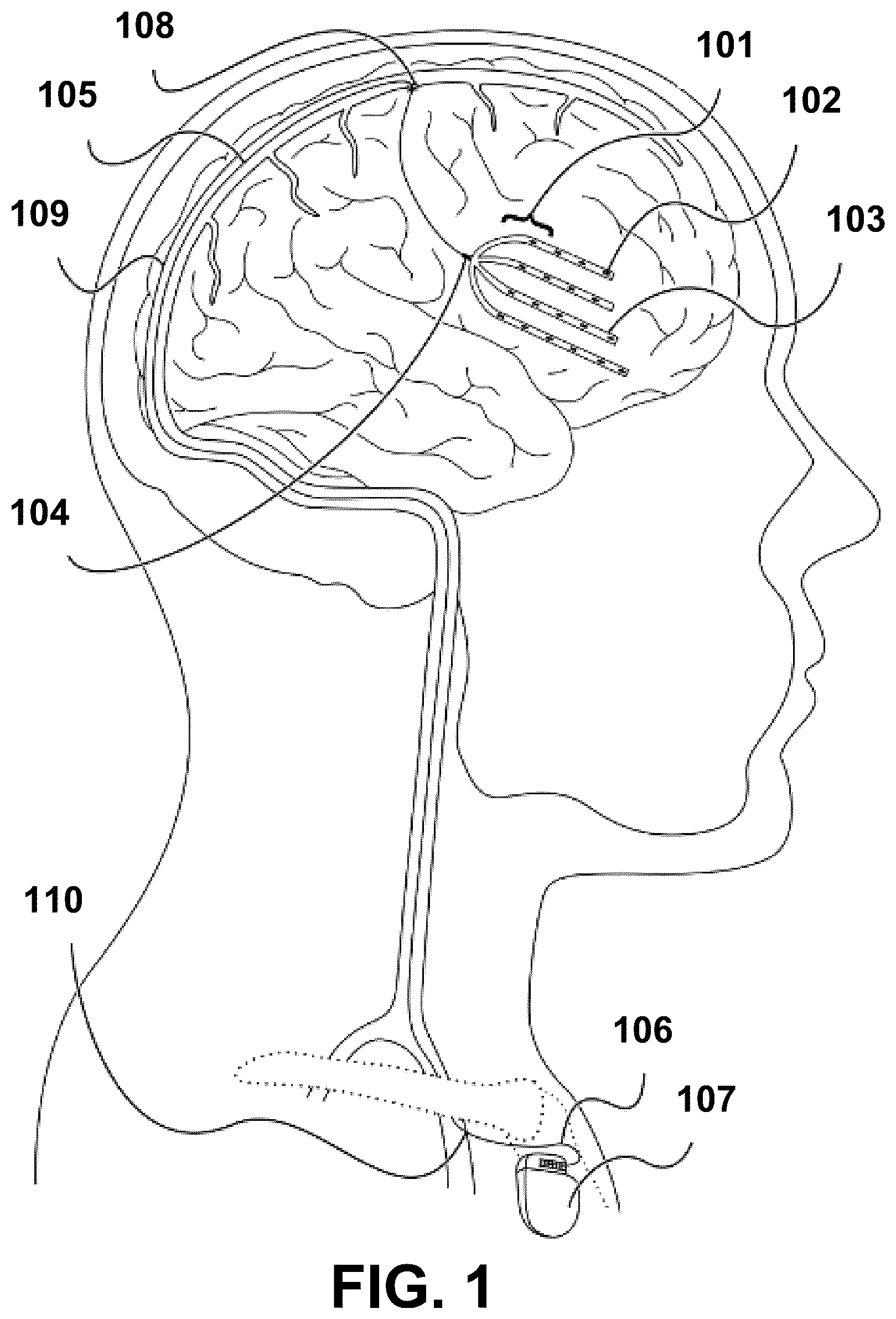 Patent US12472348 Figure 1 – Transcatheter electrode array and use thereof