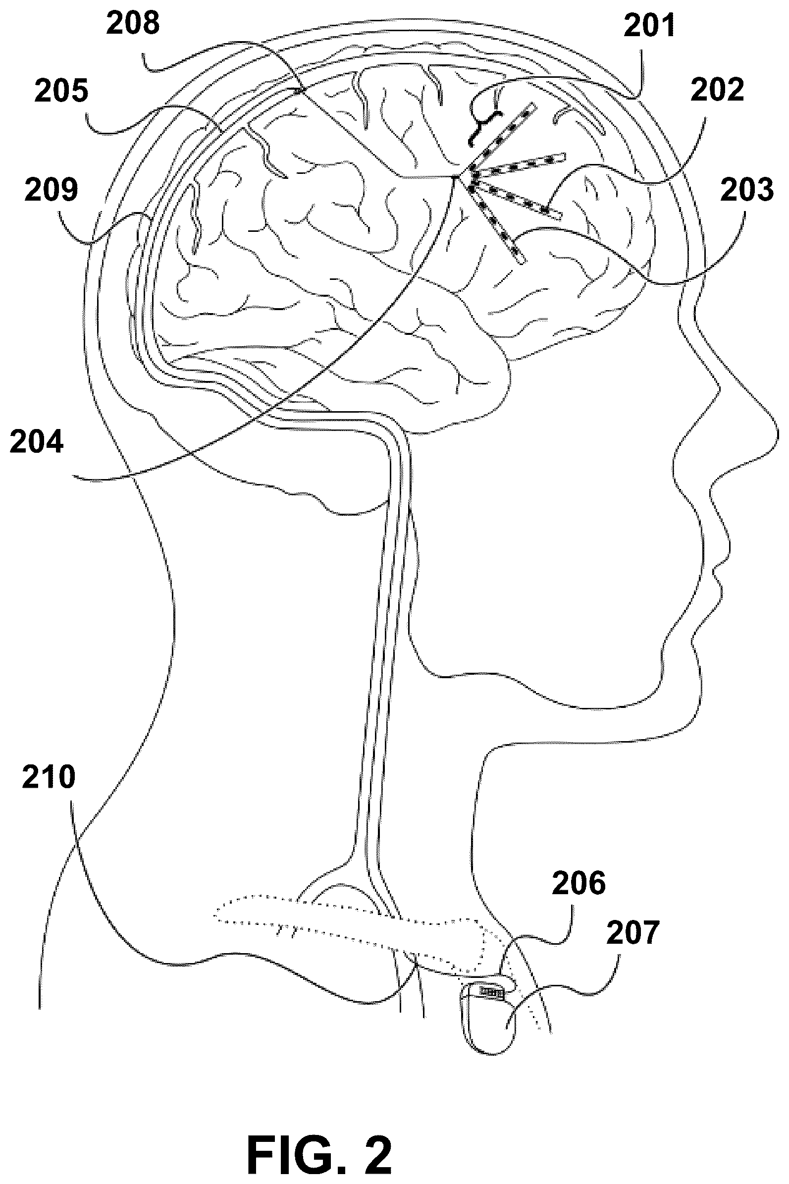 Patent US12472348 Figure 2 – Transcatheter electrode array and use thereof