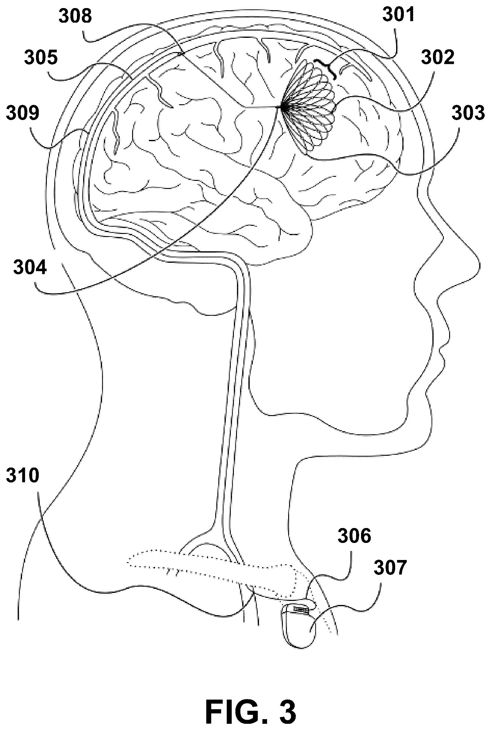 Patent US12472348 Figure 3 – Transcatheter electrode array and use thereof