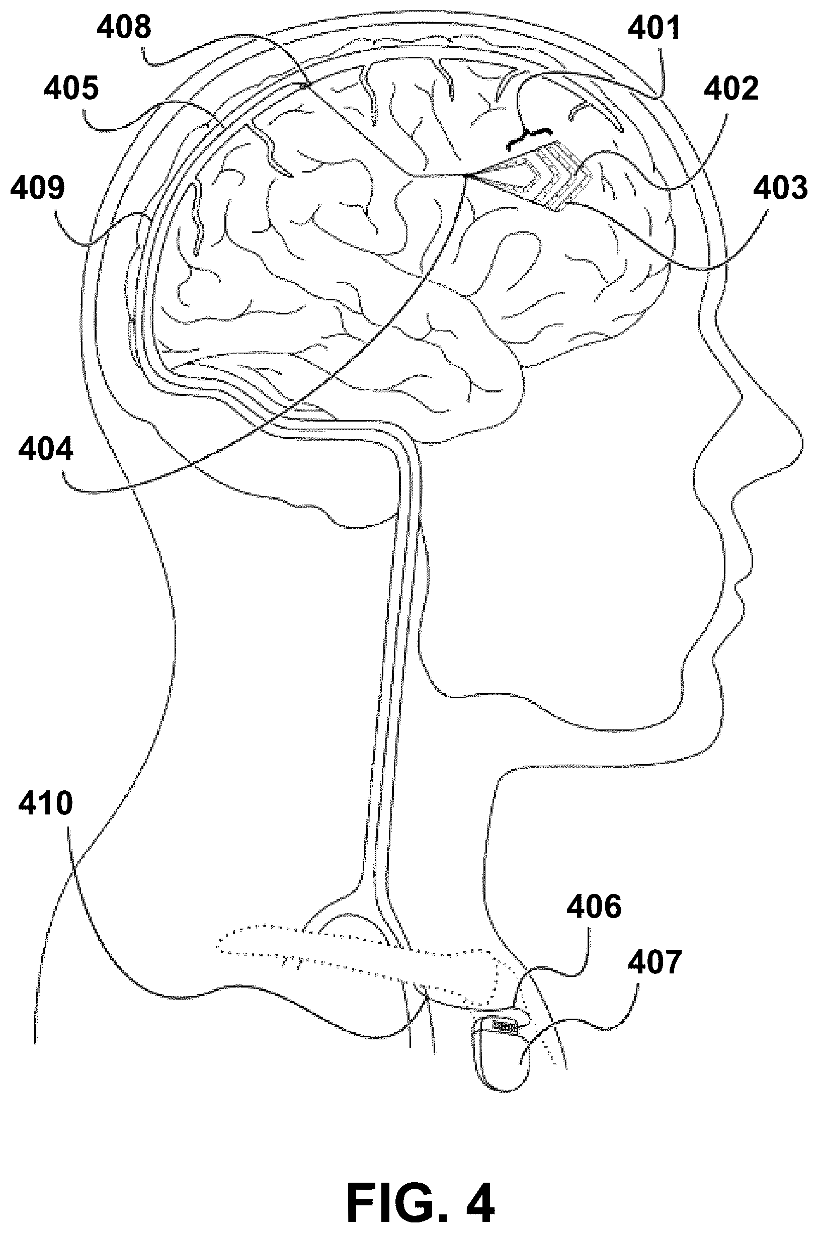 Patent US12472348 Figure 4 – Transcatheter electrode array and use thereof
