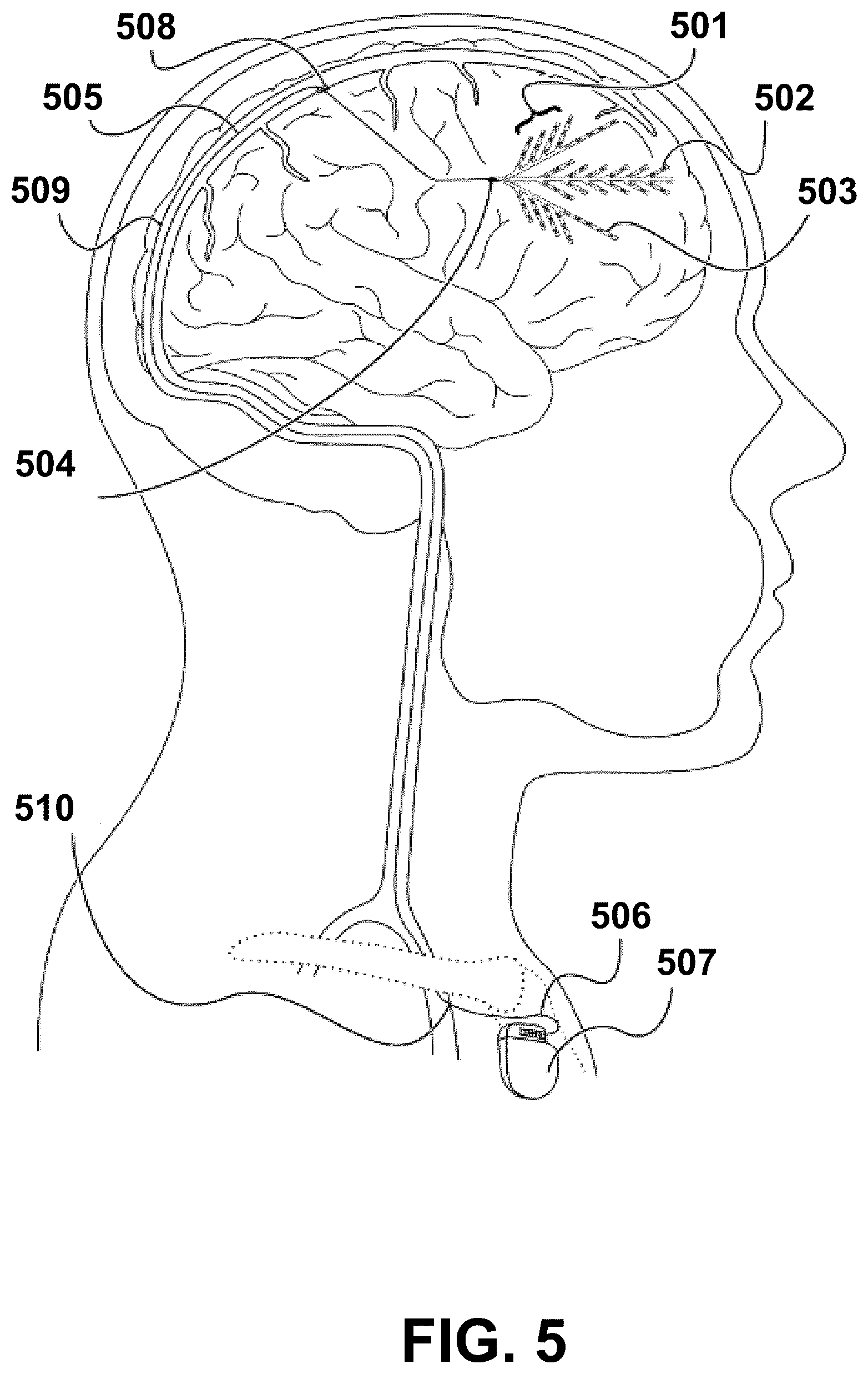 Patent US12472348 Figure 5 – Transcatheter electrode array and use thereof