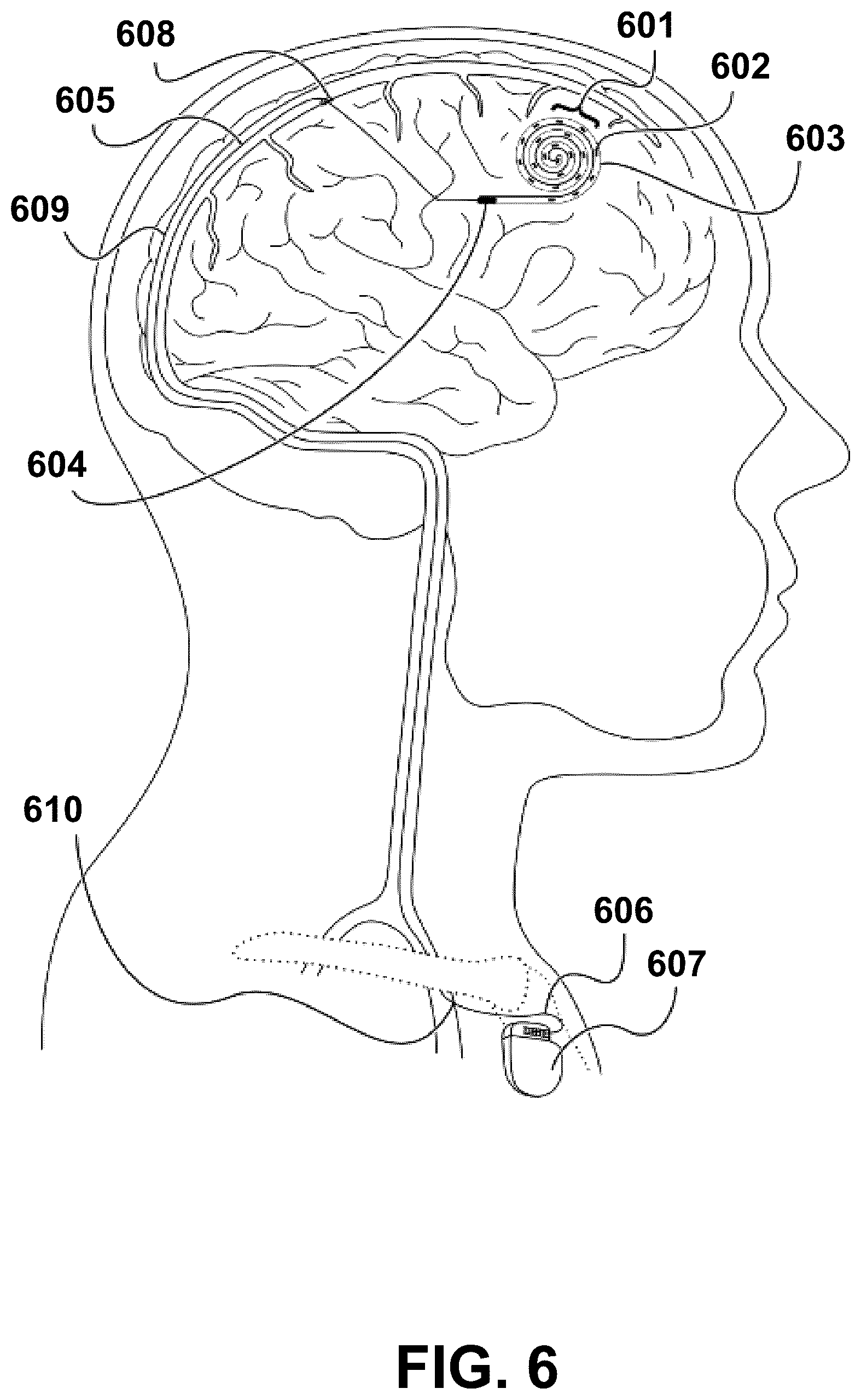 Patent US12472348 Figure 6 – Transcatheter electrode array and use thereof