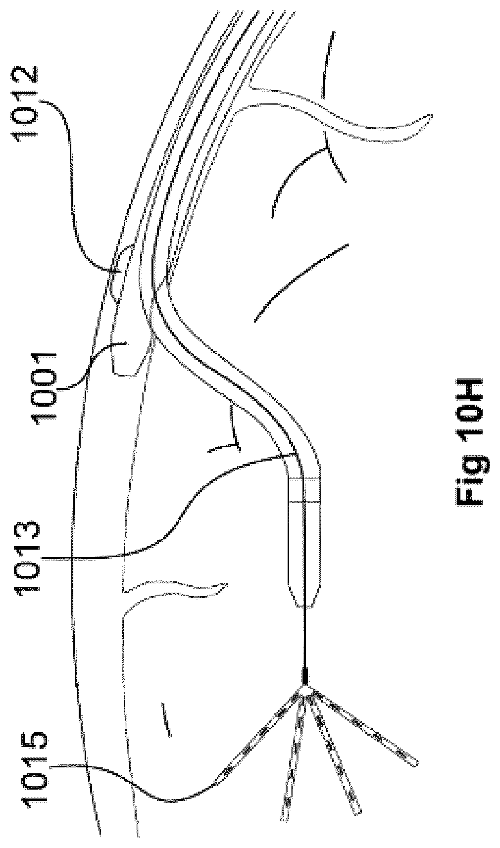 Patent US12472348 Figure 13 – Transcatheter electrode array and use thereof