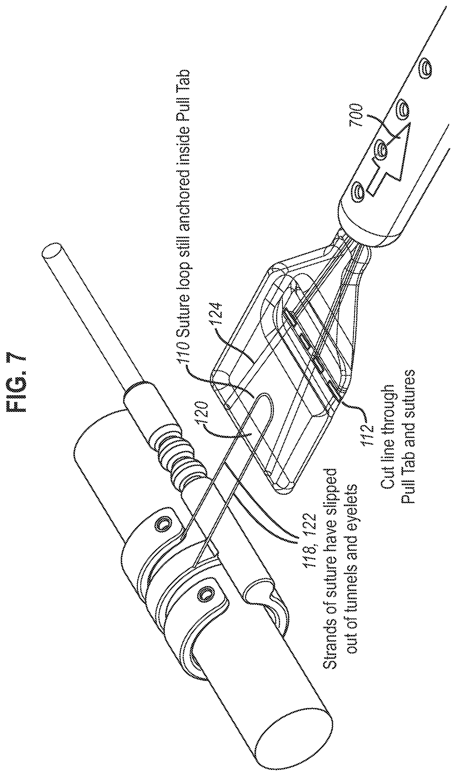 Patent US12472350 Figure 5 – Systems and methods for laparoscopic delivery and deployment of a neural interface