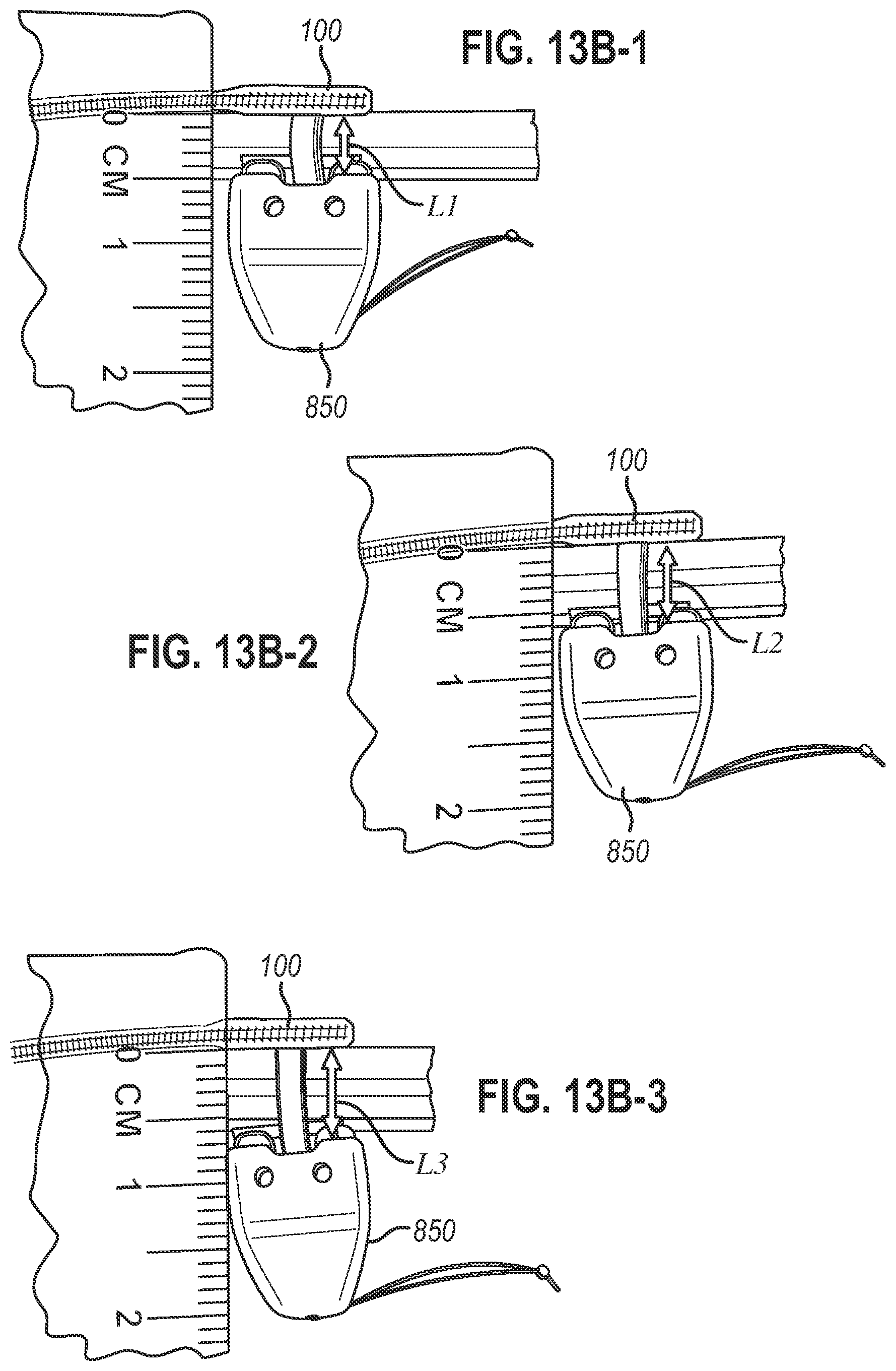 Patent US12472350 Figure 12 – Systems and methods for laparoscopic delivery and deployment of a neural interface