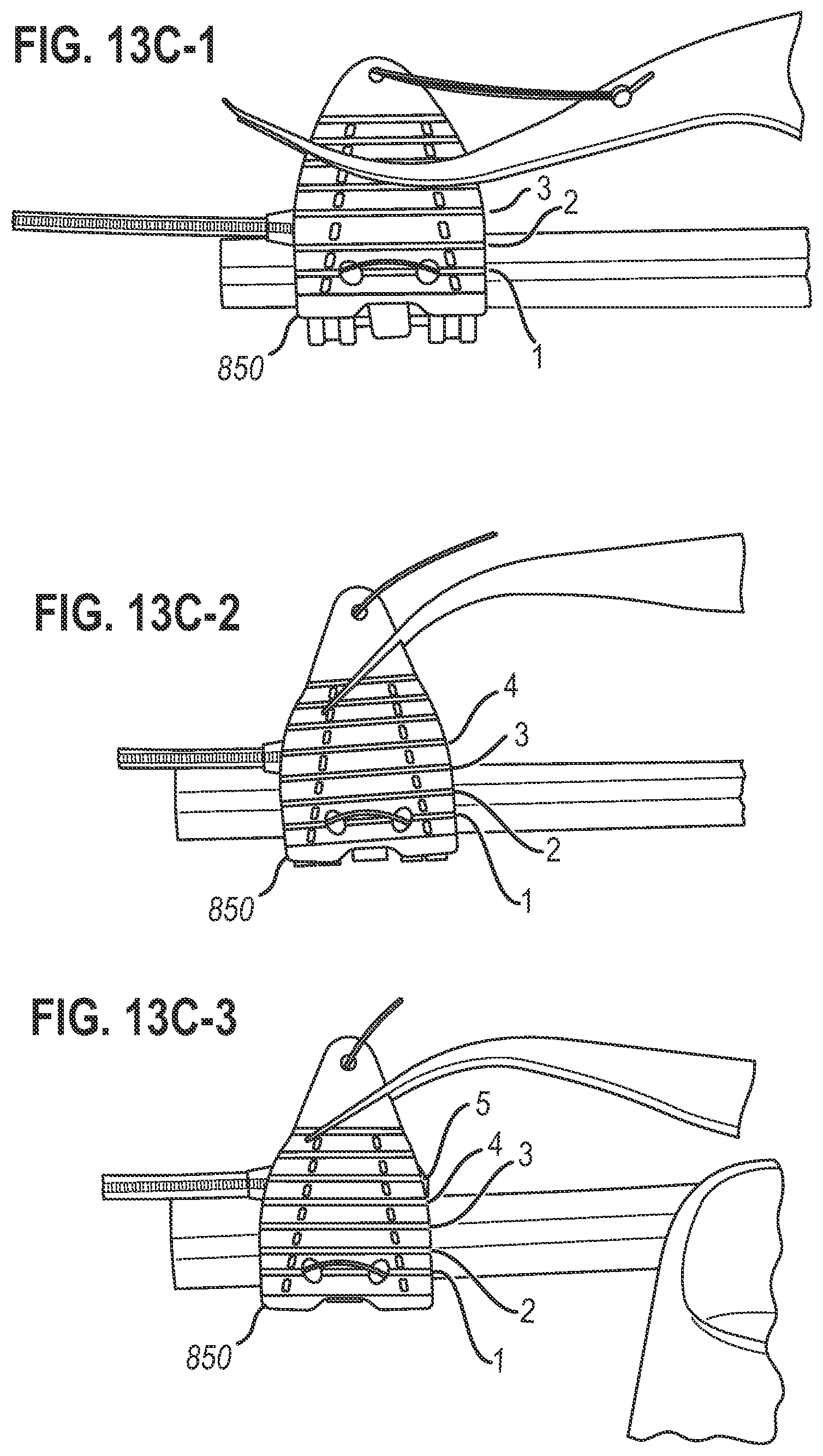 Patent US12472350 Figure 13 – Systems and methods for laparoscopic delivery and deployment of a neural interface