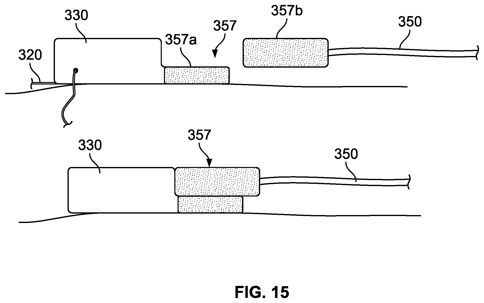 Patent US12472354 Figure 14 – Electrical stimulator for peripheral stimulation