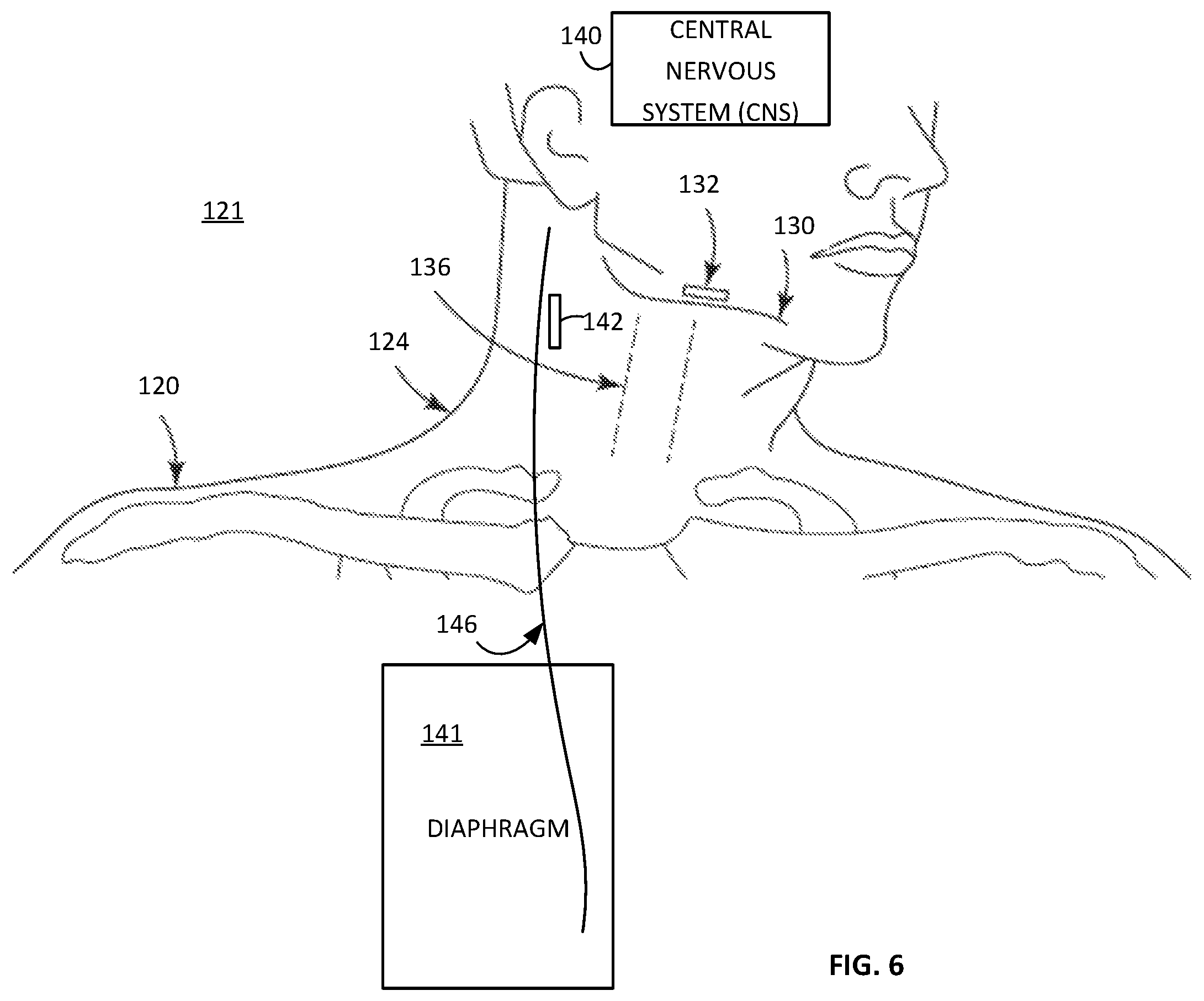 Patent US12472357 Figure 3 – Multiple type sleep apnea