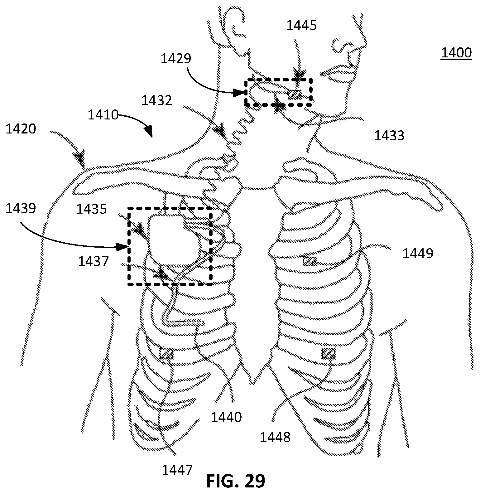 Patent US12472357 Figure 11 – Multiple type sleep apnea