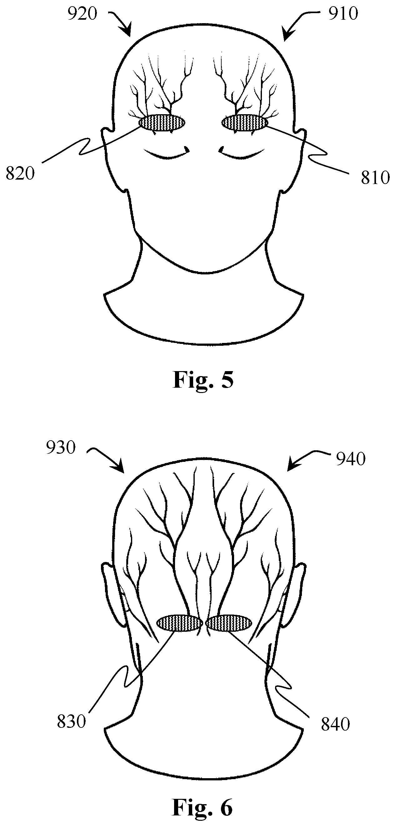 Patent US12472358 Figure 5 – Method of operating an electrical stimulation device with two or more stimulation energy supplies, and a stimulating device