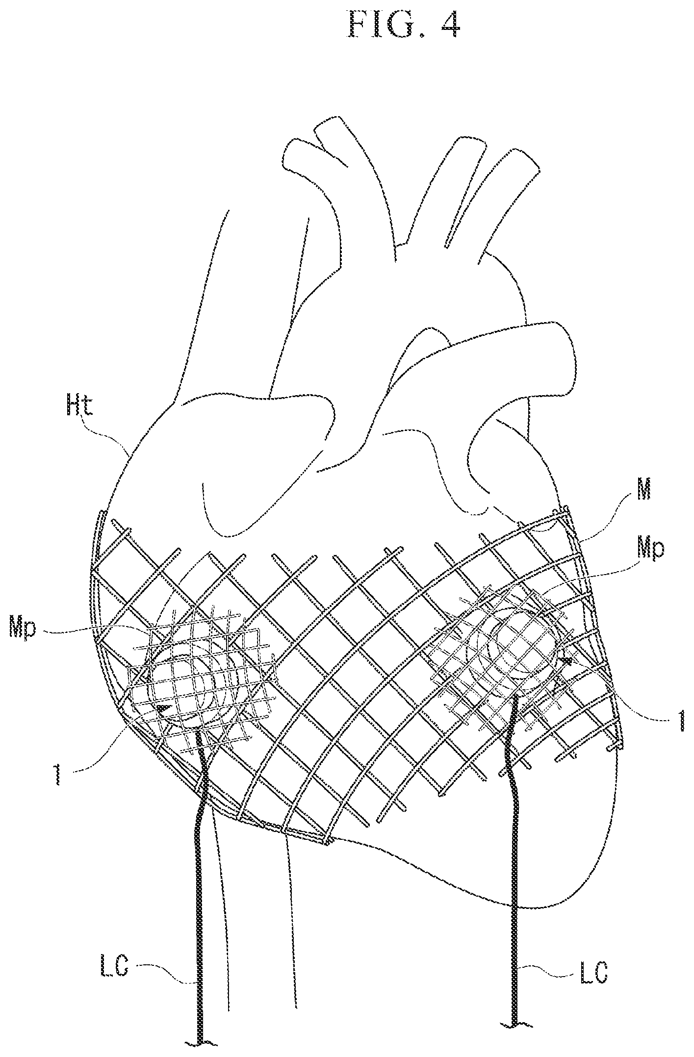 Patent US12472359 Figure 3 – Biological electrode and cardiac pacemaker