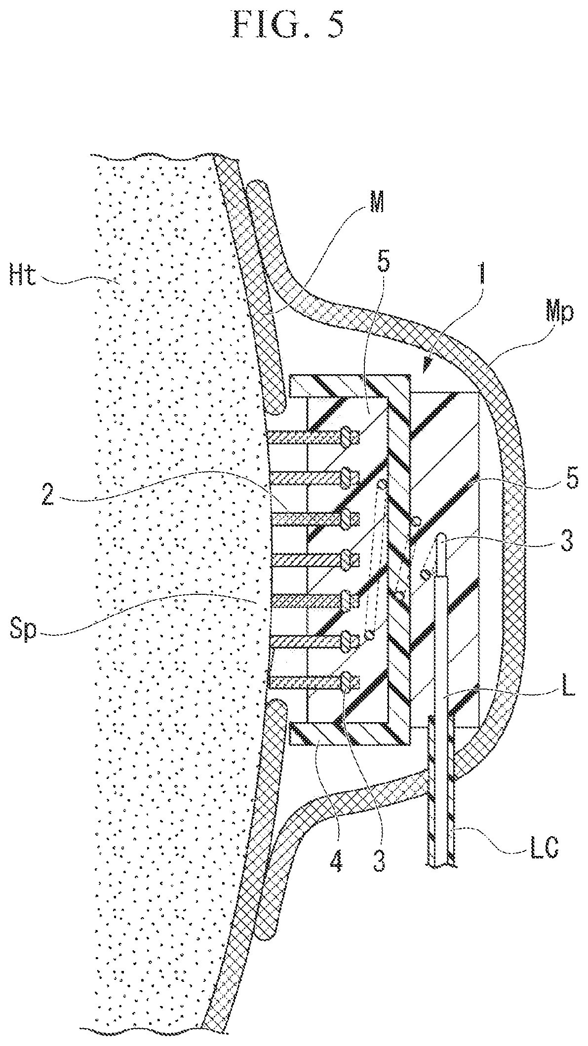 Patent US12472359 Figure 4 – Biological electrode and cardiac pacemaker