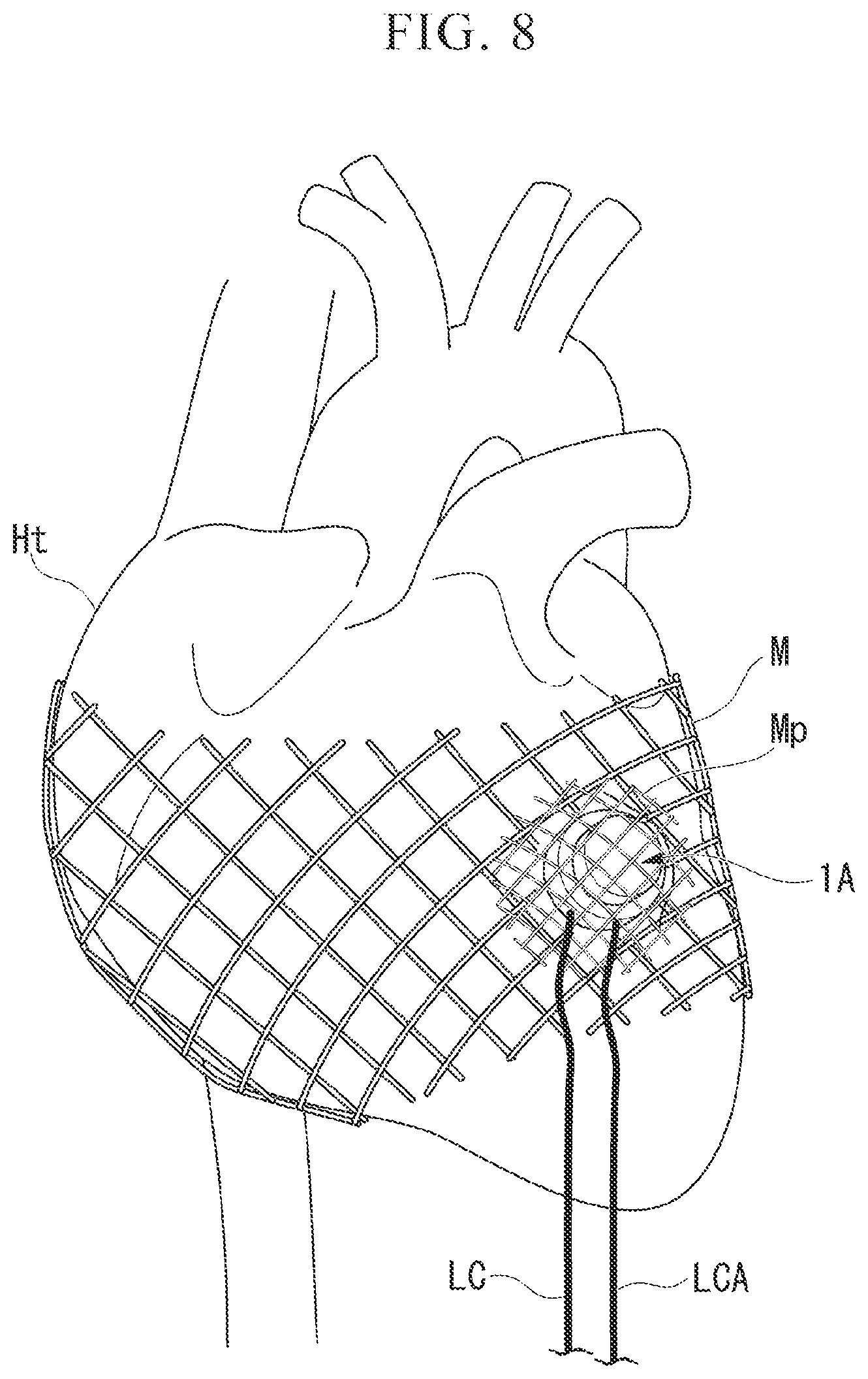 Patent US12472359 Figure 7 – Biological electrode and cardiac pacemaker