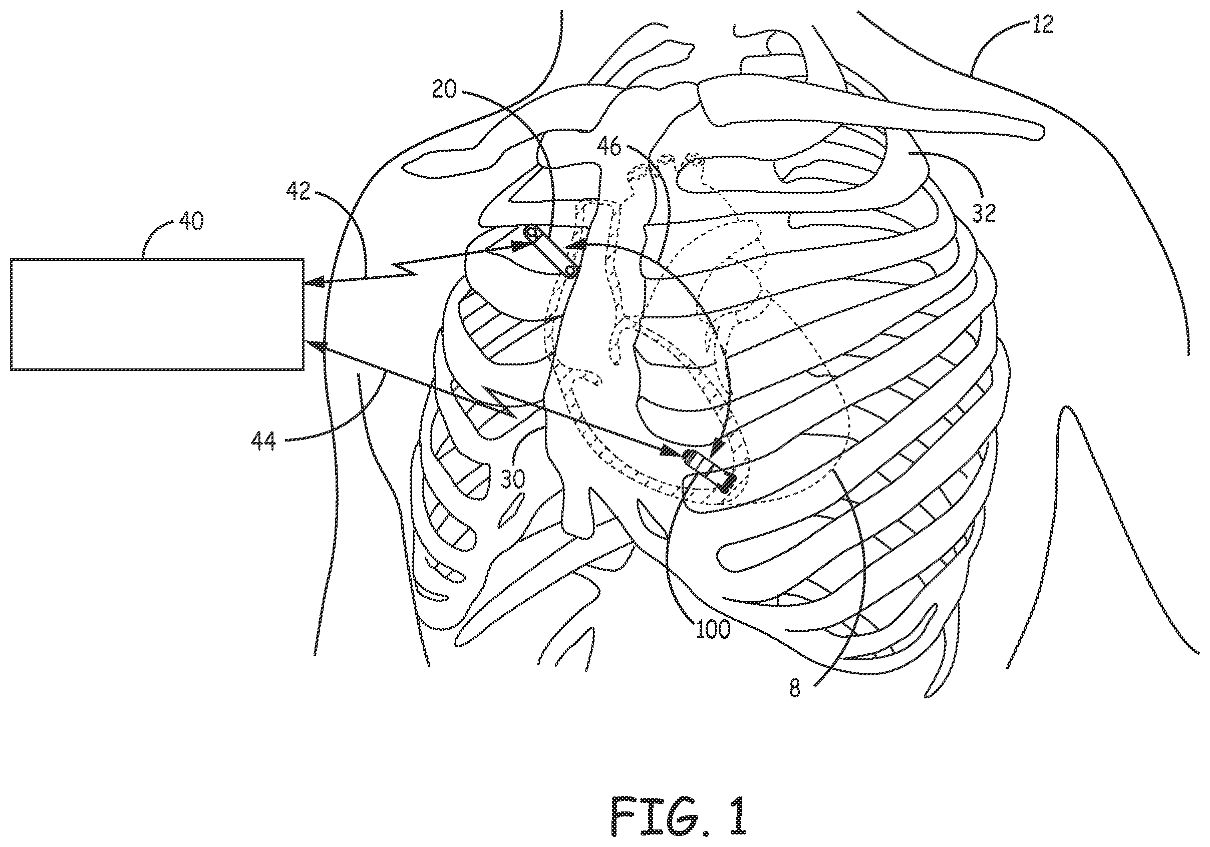 Patent US12472361 Figure 1 – Atrial synchronized ventricular pacing system
