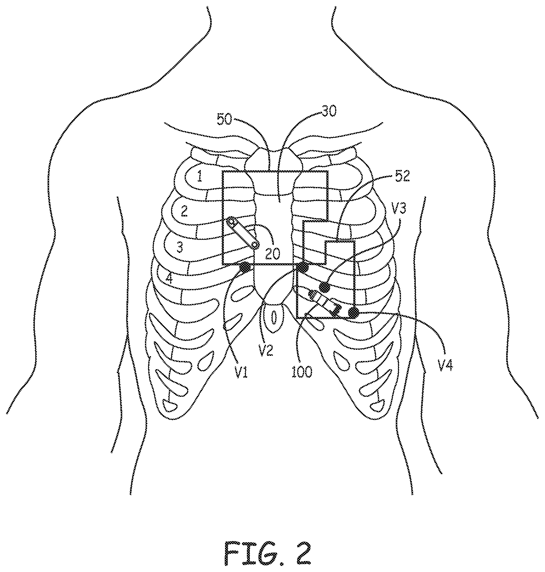 Patent US12472361 Figure 2 – Atrial synchronized ventricular pacing system