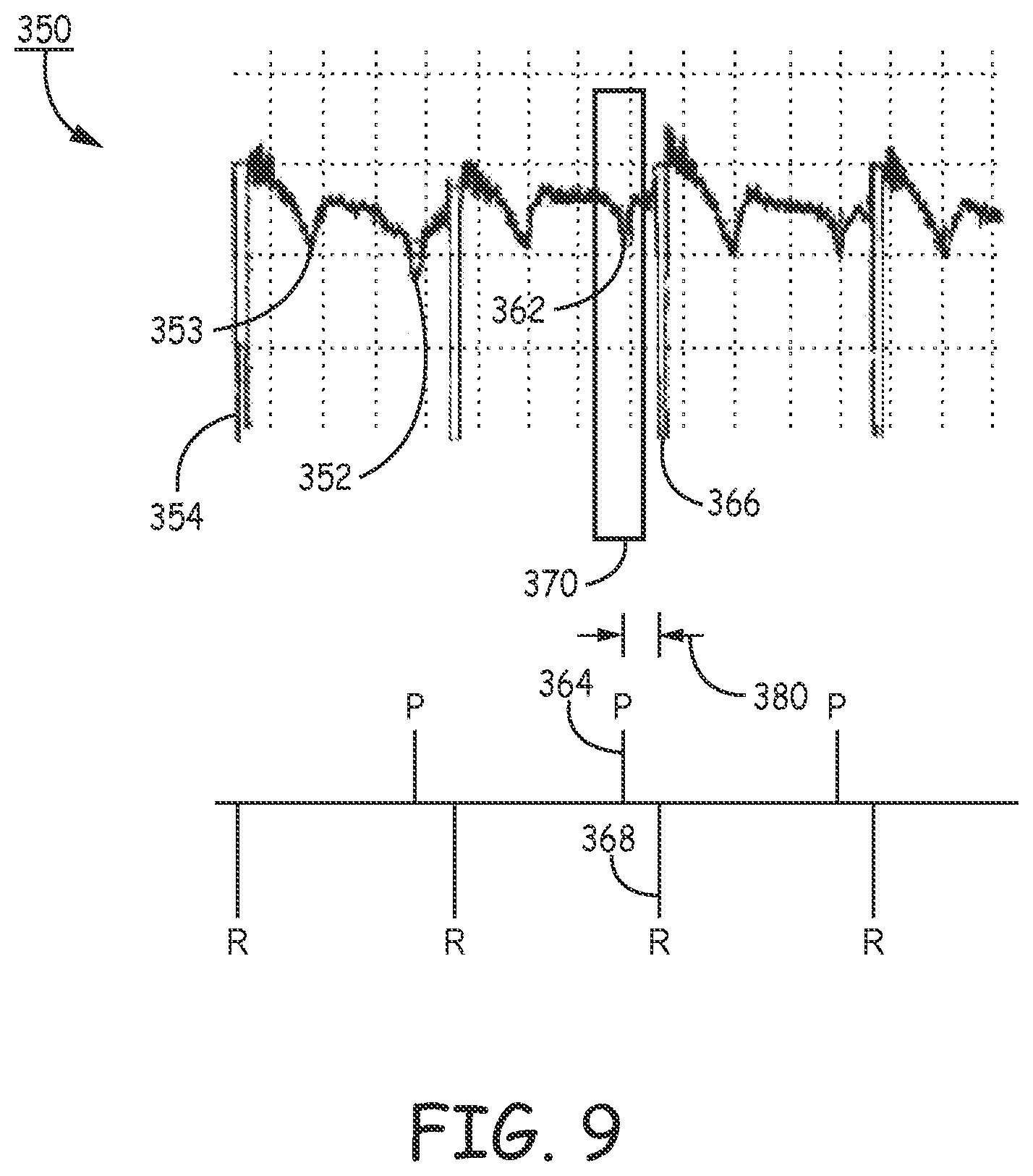 Patent US12472361 Figure 11 – Atrial synchronized ventricular pacing system