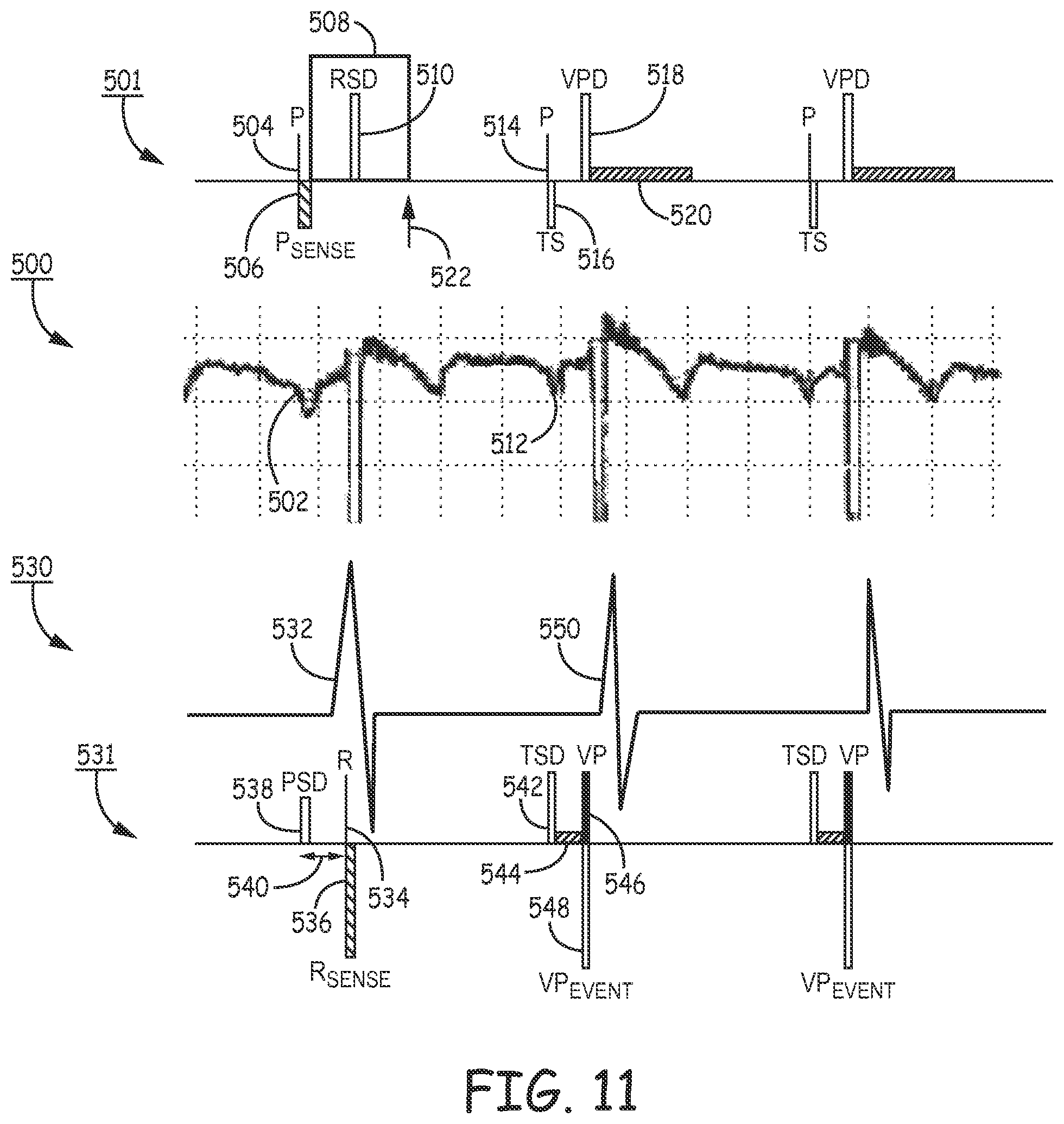 Patent US12472361 Figure 13 – Atrial synchronized ventricular pacing system