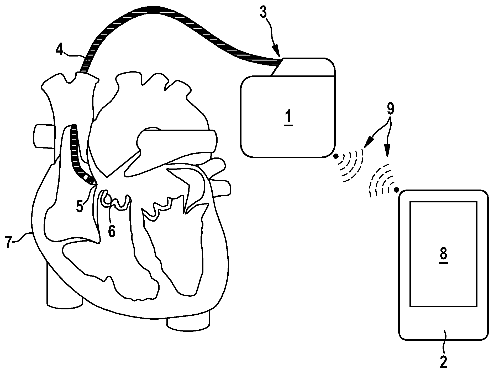 Patent US12472362 — Programming device for programming an implantable medical device for stimulating a human or animal heart — Figure 1