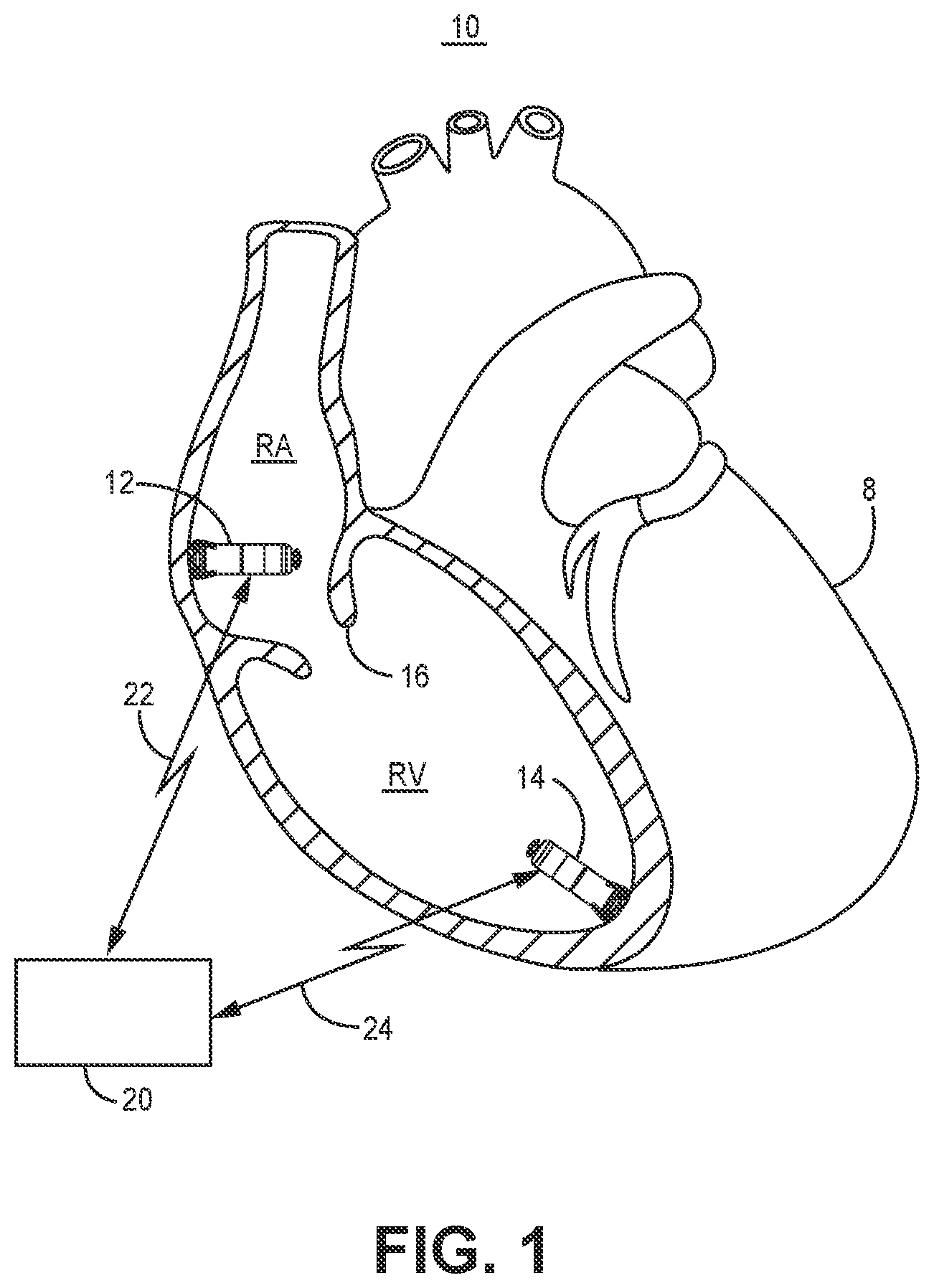 Patent US12472363 Figure 1 – Pacing mode switching in a ventricular pacemaker