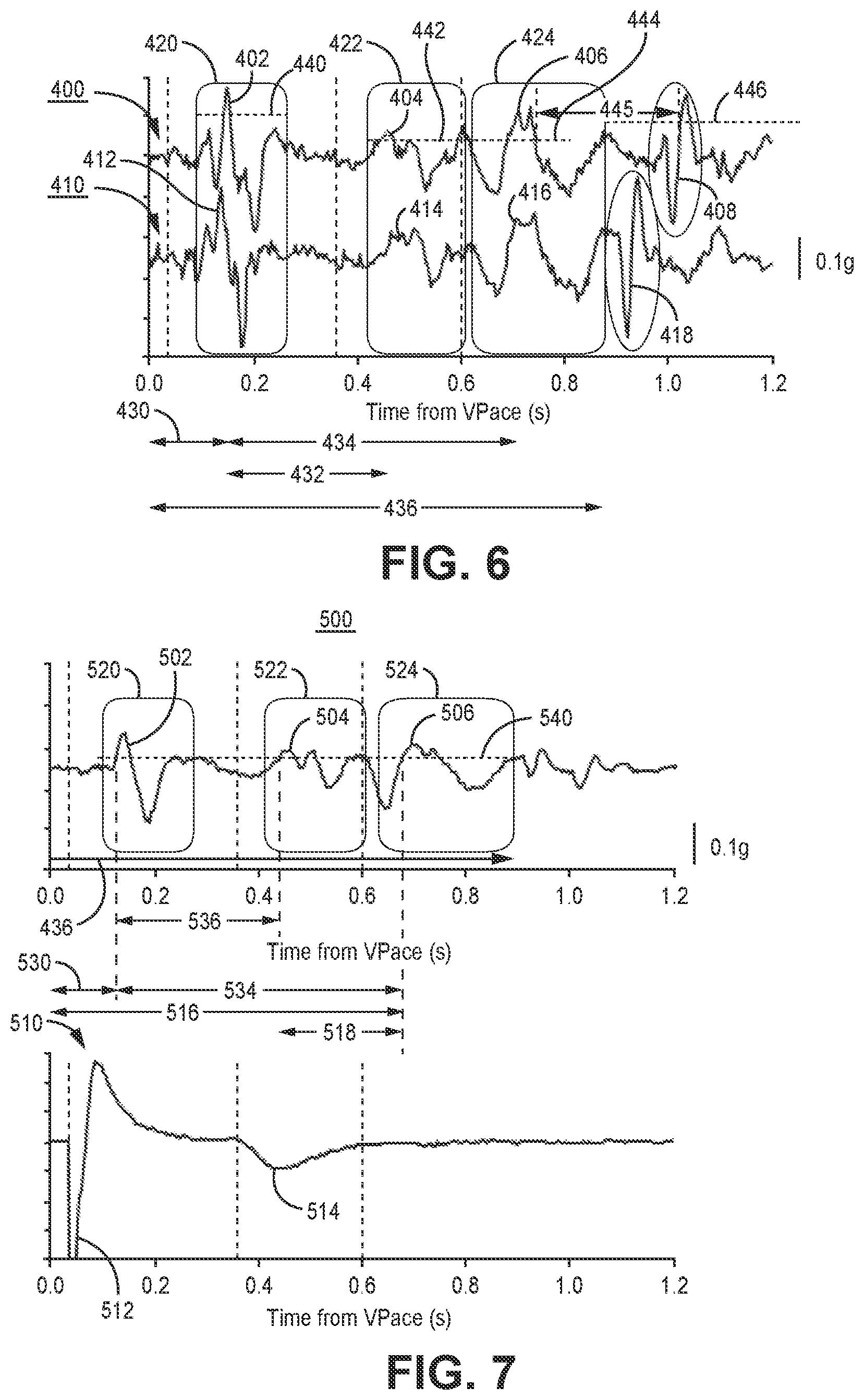 Patent US12472363 Figure 6 – Pacing mode switching in a ventricular pacemaker
