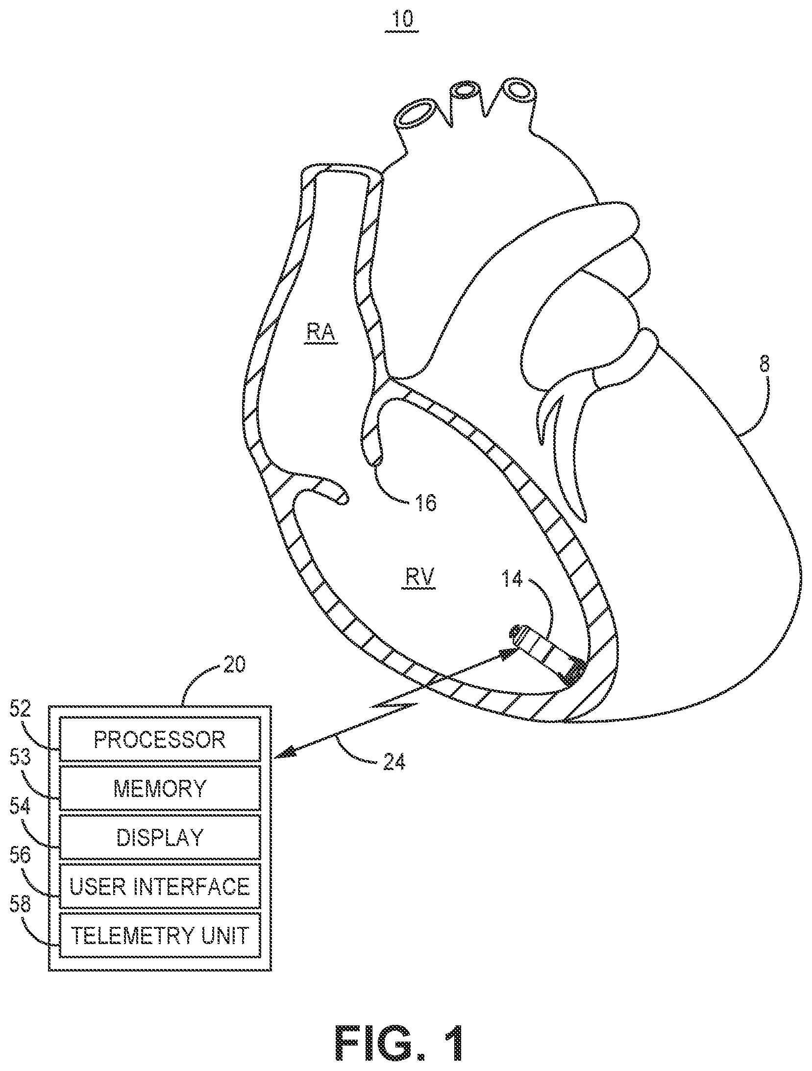 Patent US12472364 — Post-ventricular atrial blanking in a cardiac device — Figure 1