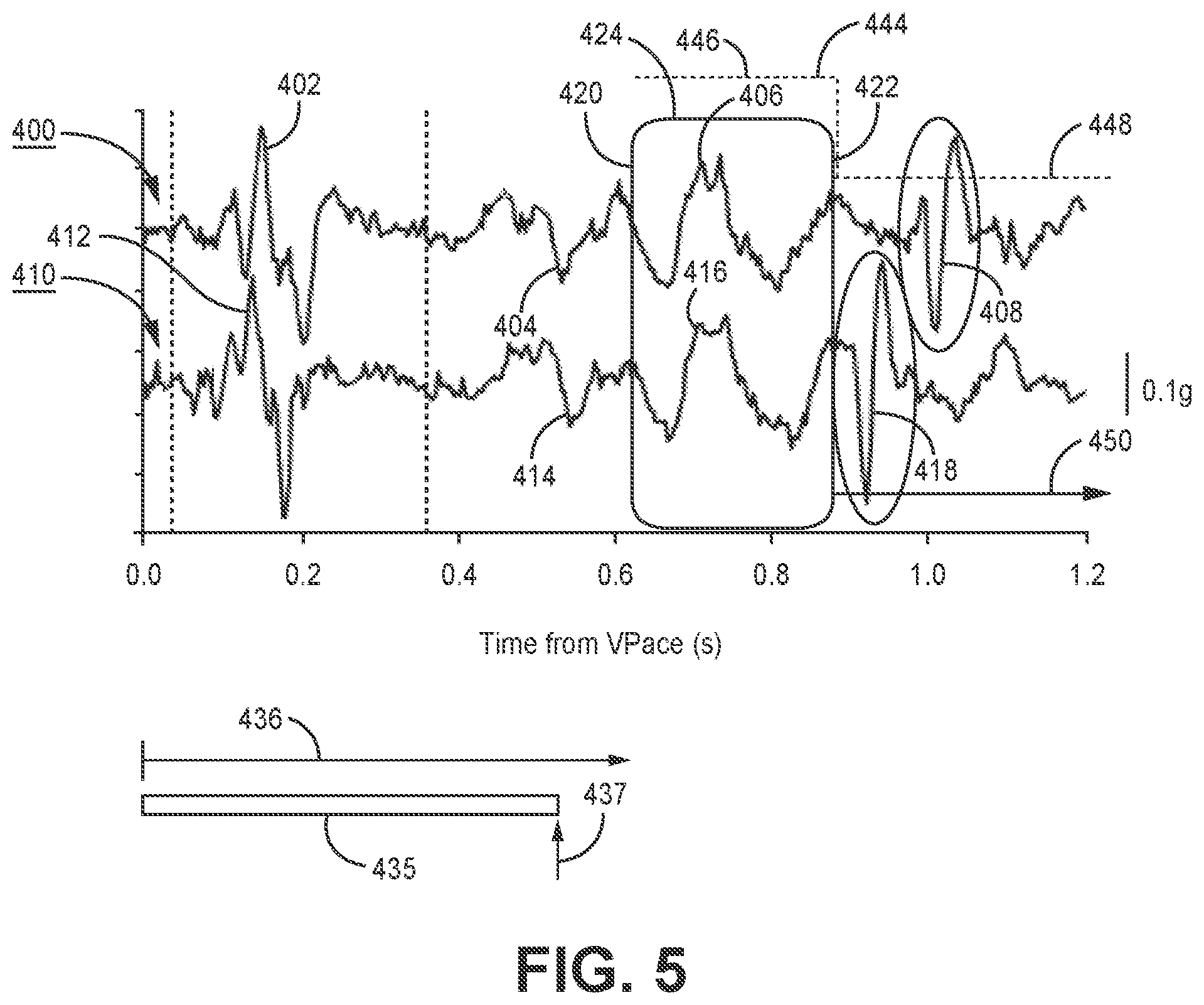 Patent US12472364 Figure 5 – Post-ventricular atrial blanking in a cardiac device