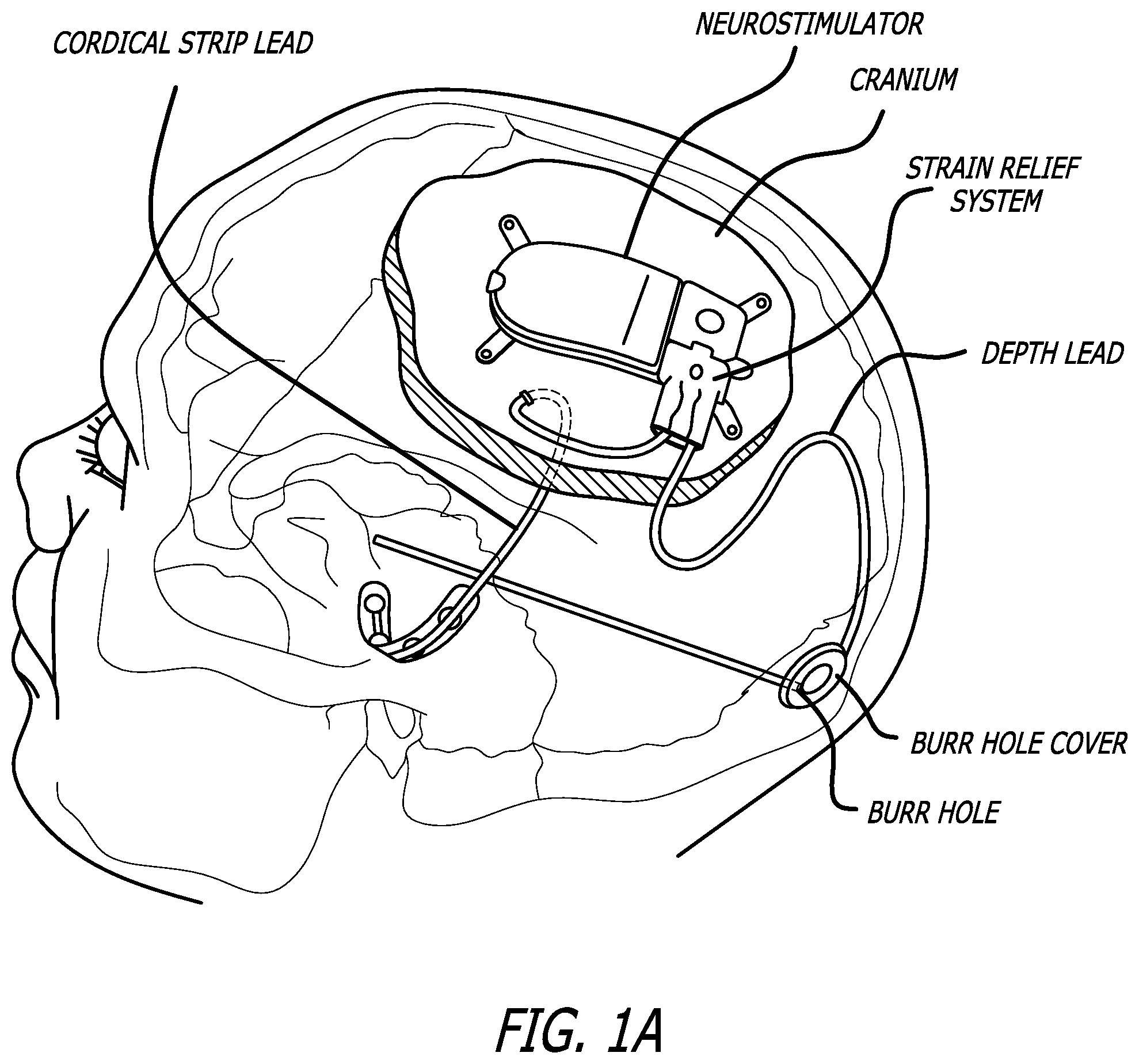 Patent US12472367 Figure 1 – Strain relief systems for active implantable medical devices