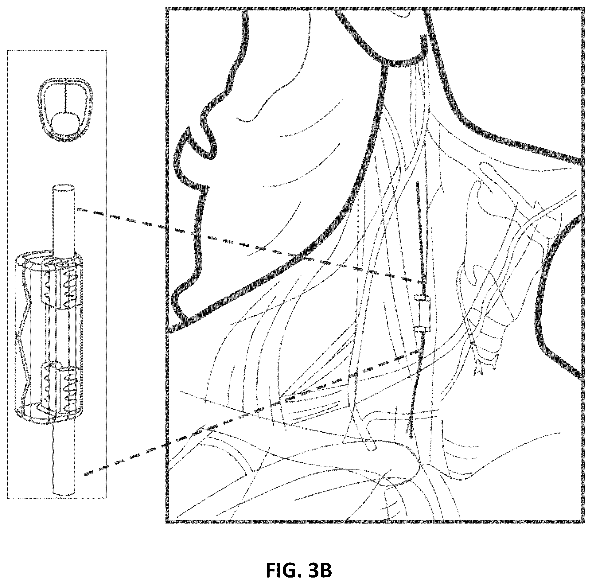 Patent US12472368 Figure 5 – Implantable neurostimulator having power control and thermal regulation and methods of use