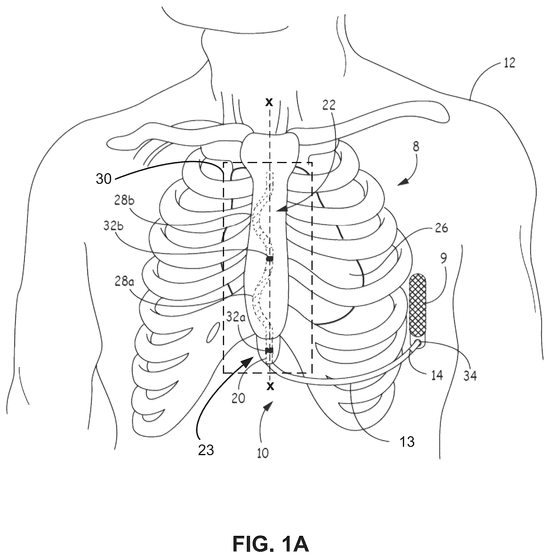 Patent US12472369 Figure 1 – Implantable medical lead shield