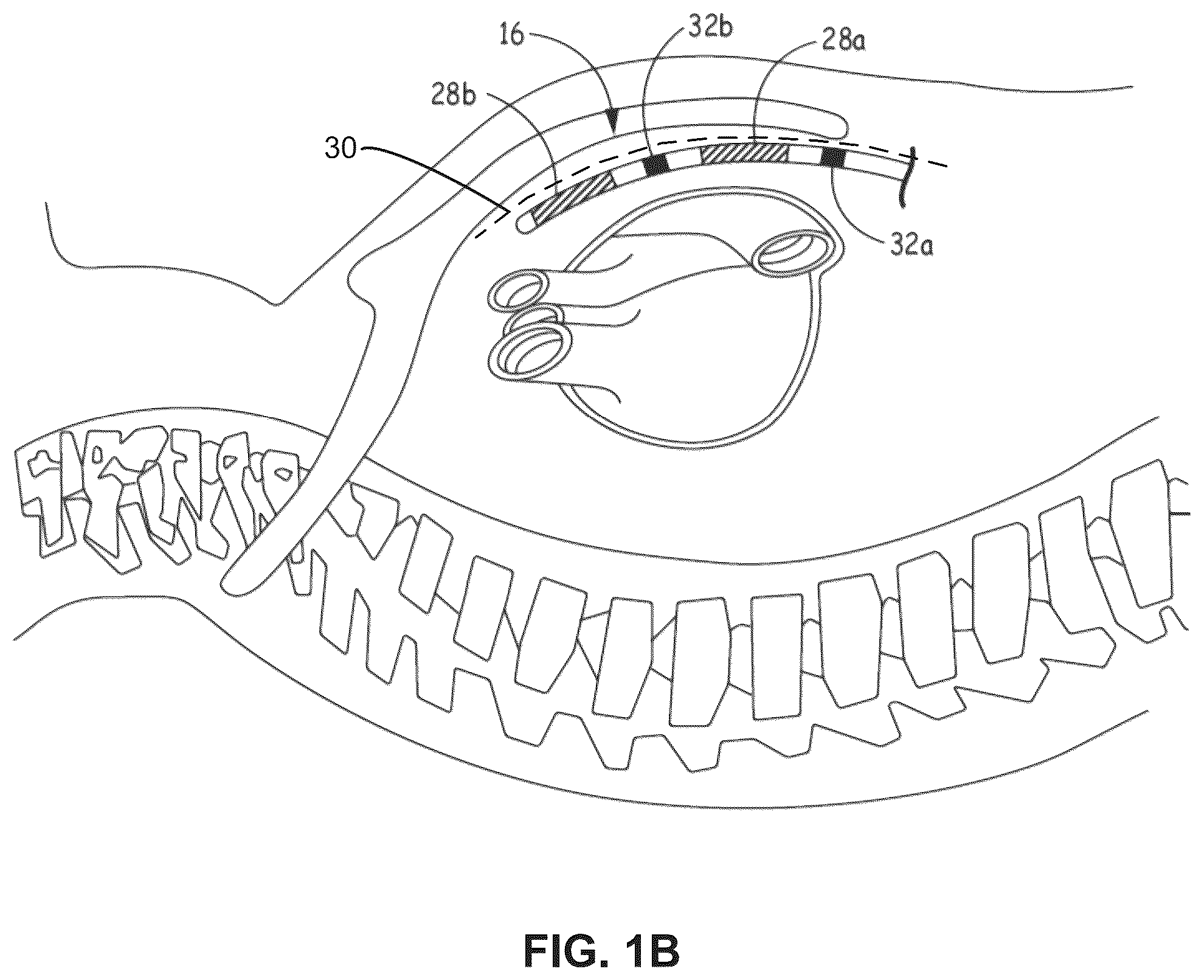 Patent US12472369 Figure 2 – Implantable medical lead shield