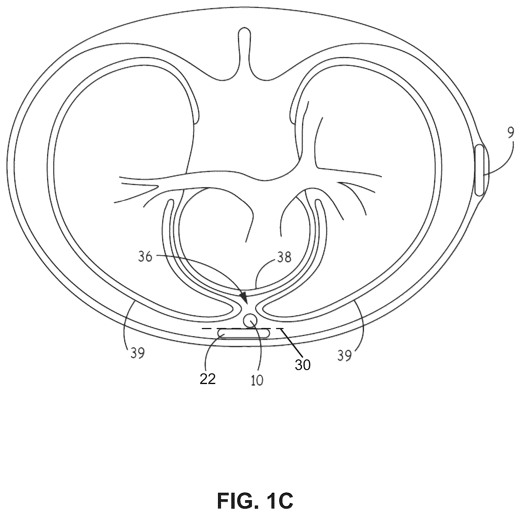Patent US12472369 Figure 3 – Implantable medical lead shield