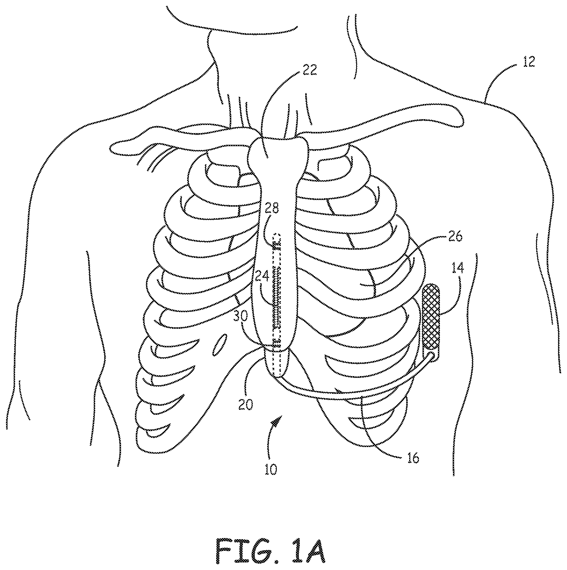 Patent US12472370 — Implantable cardioverter-defibrillator (ICD) system including substernal lead — Figure 1