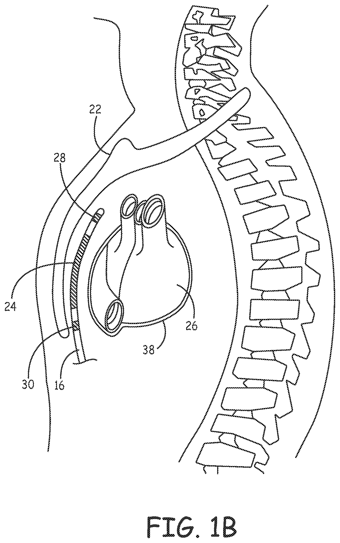 Patent US12472370 Figure 2 – Implantable cardioverter-defibrillator (ICD) system including substernal lead