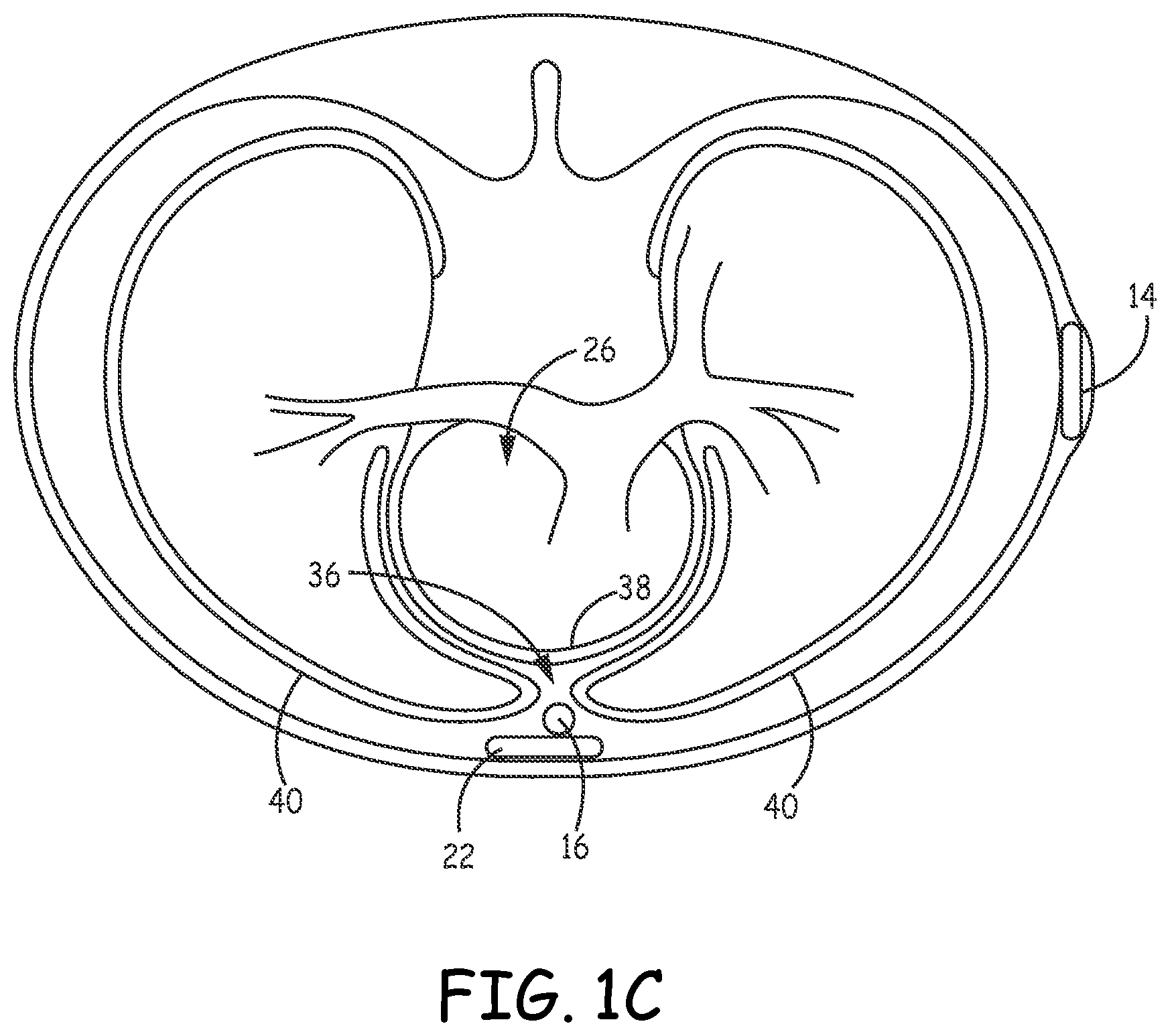 Patent US12472370 Figure 3 – Implantable cardioverter-defibrillator (ICD) system including substernal lead