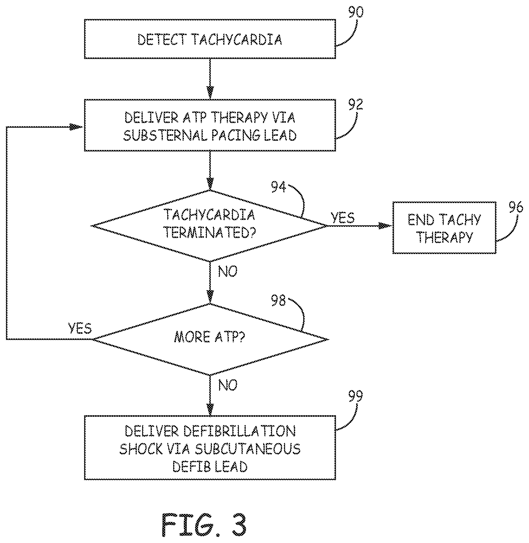 Patent US12472370 Figure 5 – Implantable cardioverter-defibrillator (ICD) system including substernal lead
