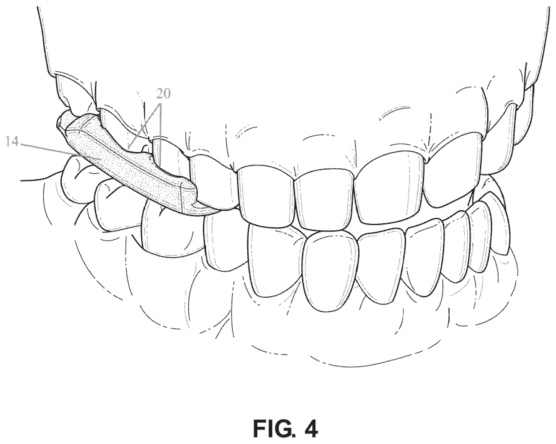 Patent US12472421 Figure 4 – Dental guard and tray and method of forming such
