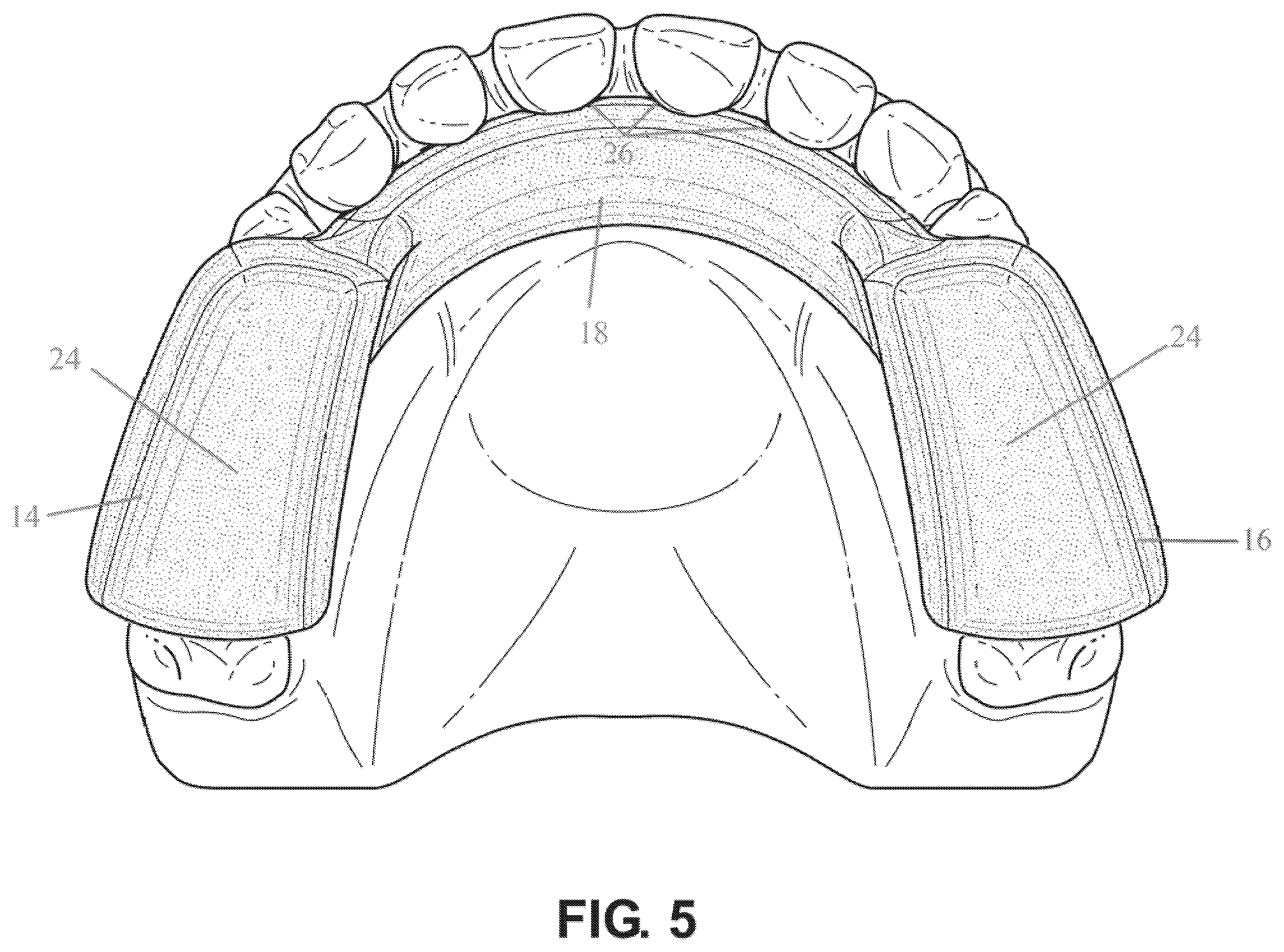 Patent US12472421 Figure 5 – Dental guard and tray and method of forming such