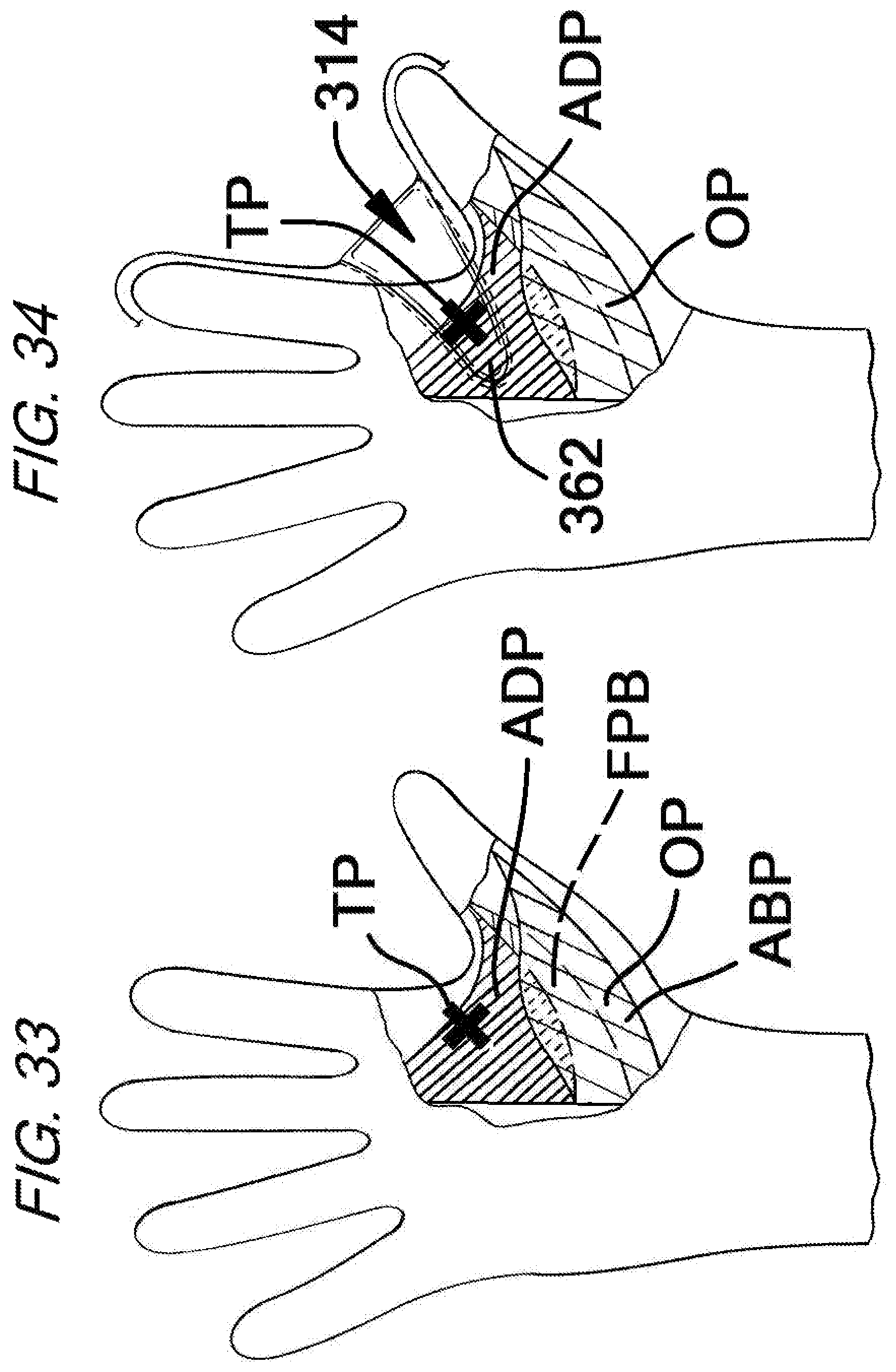 Patent US12472422 Figure 17 – Batting glove and cushioning apparatus
