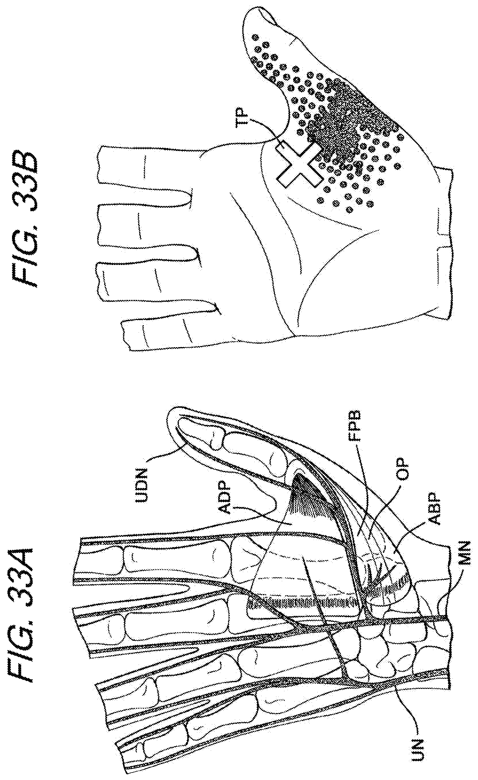 Patent US12472422 Figure 18 – Batting glove and cushioning apparatus