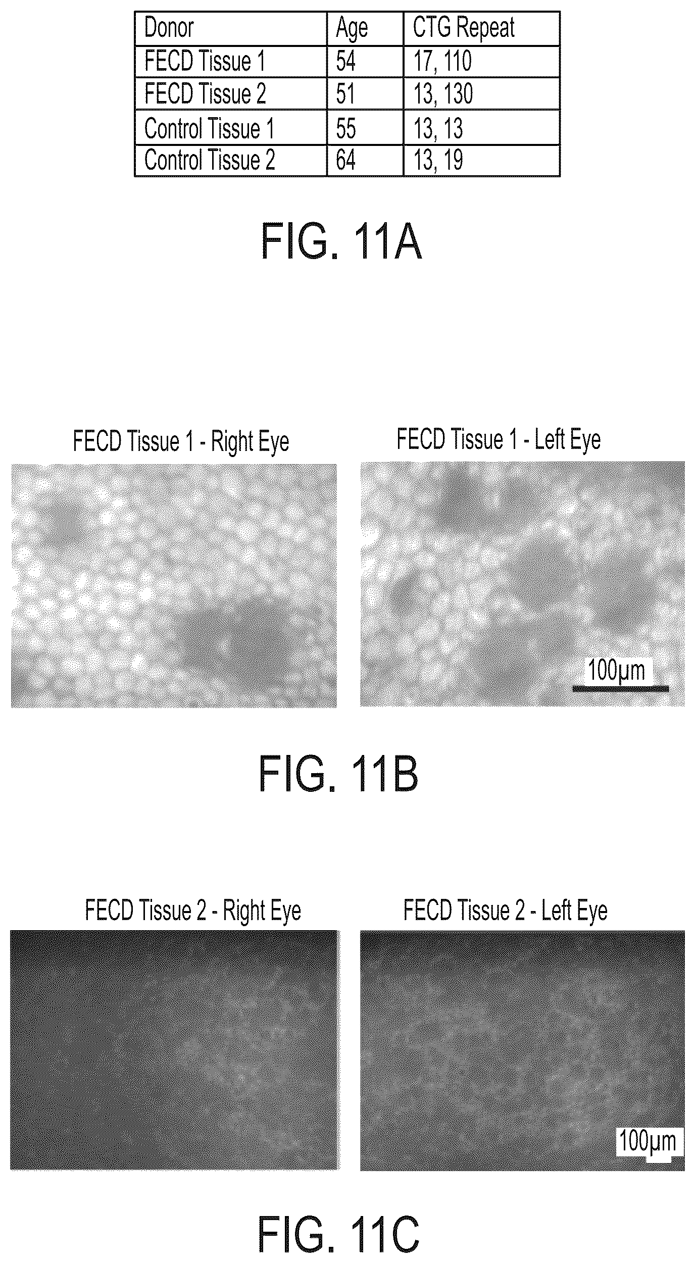 Patent US12480118 Figure 14 – Treatment of Fuchs' endothelial corneal dystrophy