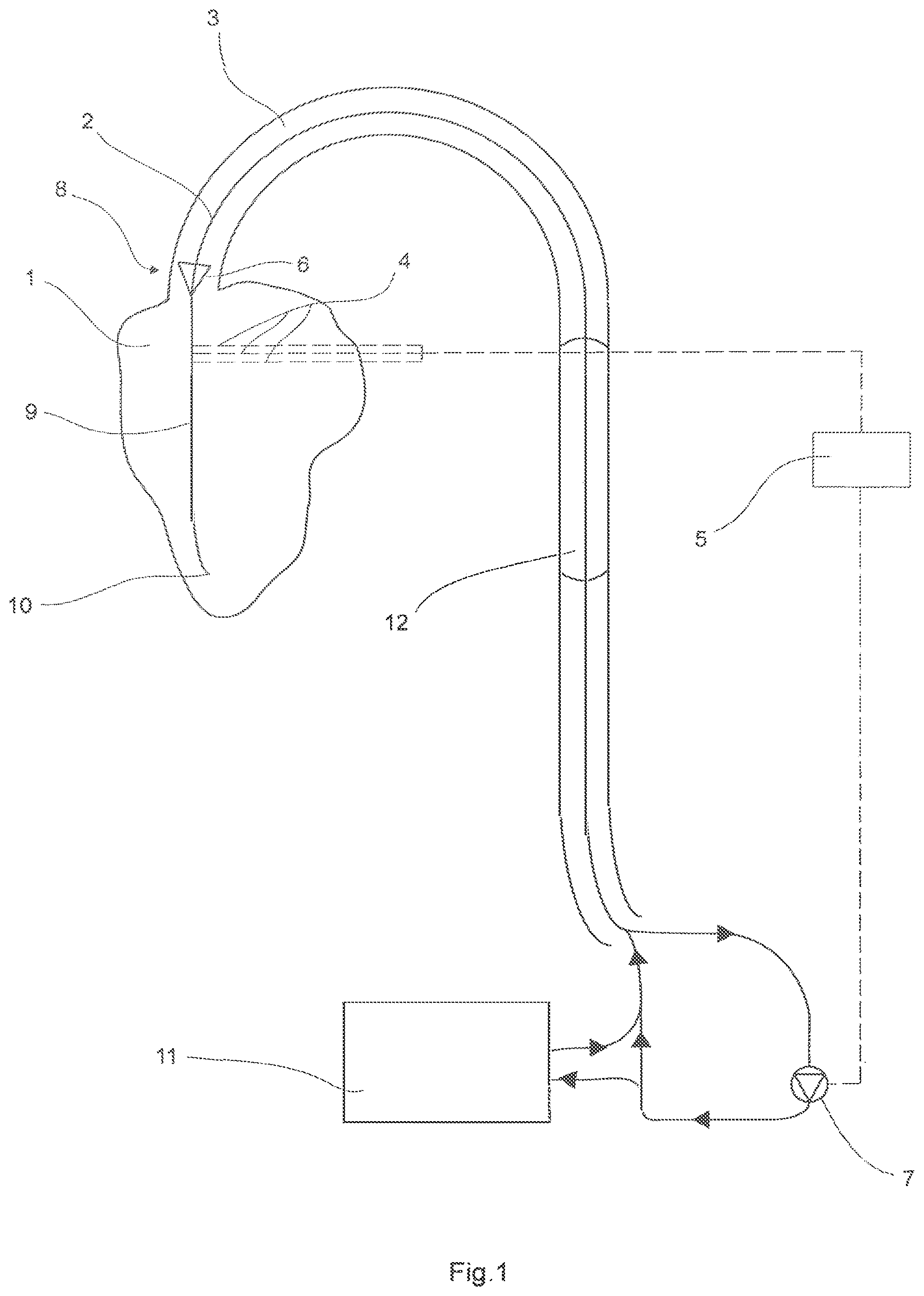 Patent US12480496 — Device to assist the performance of a heart — Figure 1