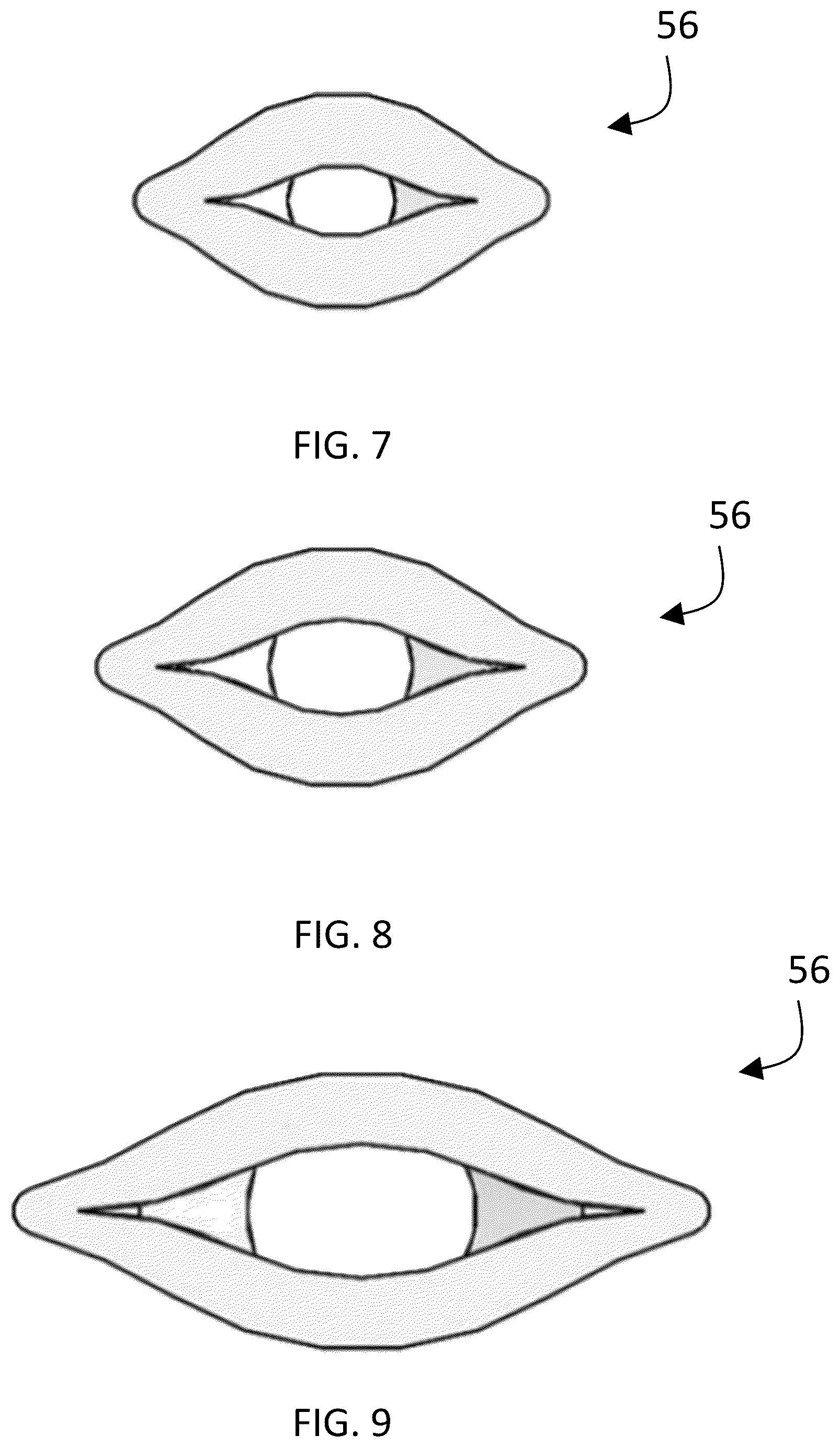 Patent US12480606 Figure 5 – Pinch valve tubes useful with pinch valve systems