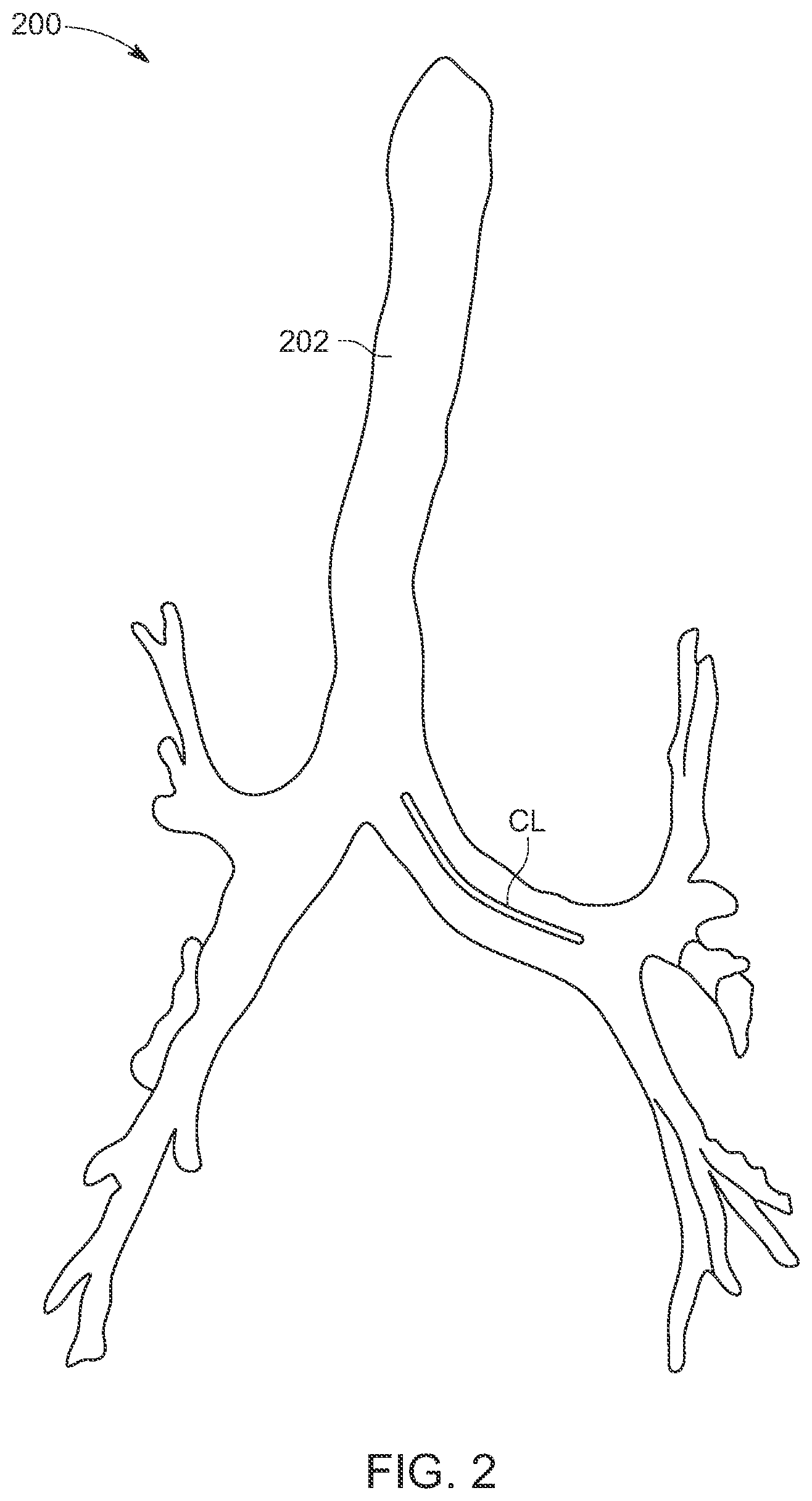 Patent US12488534 Figure 2 – Enhanced stock stents based on population modeling of tubular anatomical structures