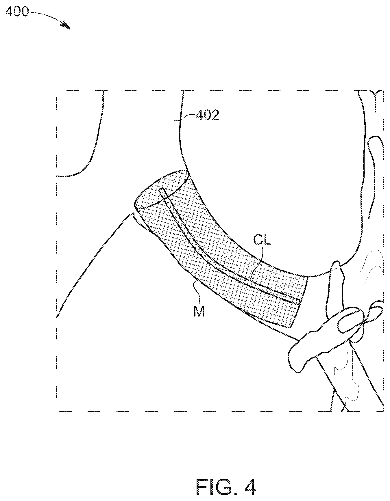 Patent US12488534 Figure 4 – Enhanced stock stents based on population modeling of tubular anatomical structures