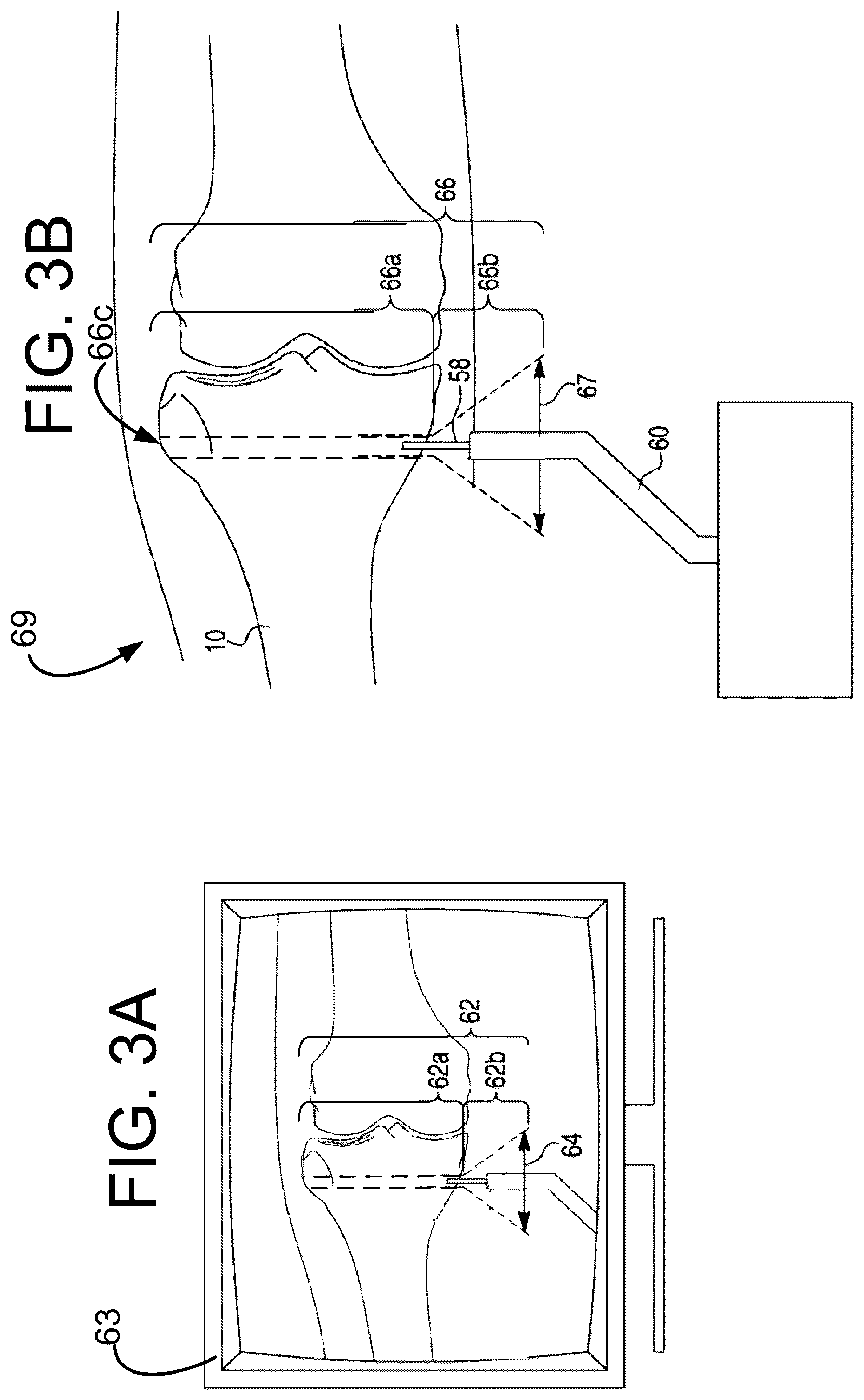Patent US12491031 Figure 3 – Preoperative planning and associated intraoperative registration for a surgical system