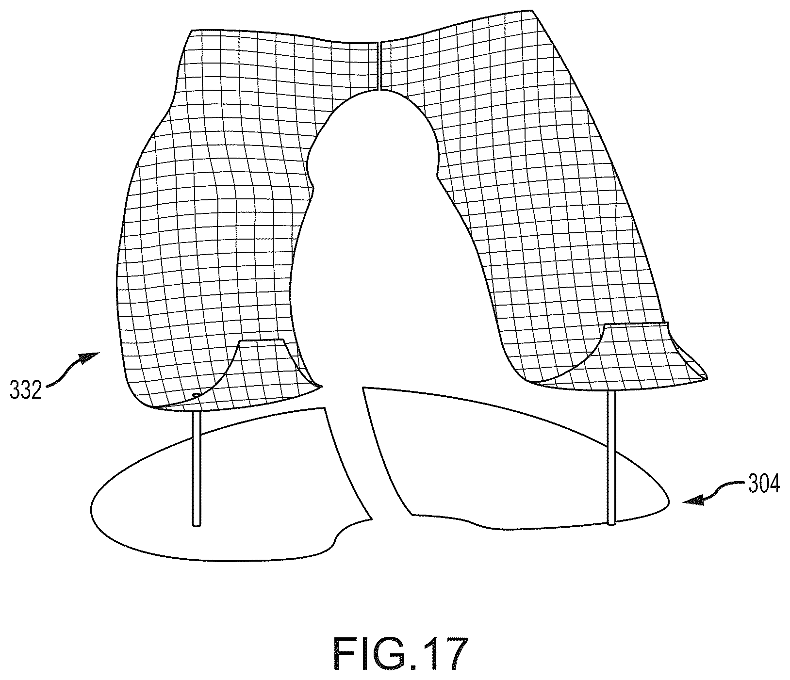 Patent US12491031 Figure 17 – Preoperative planning and associated intraoperative registration for a surgical system