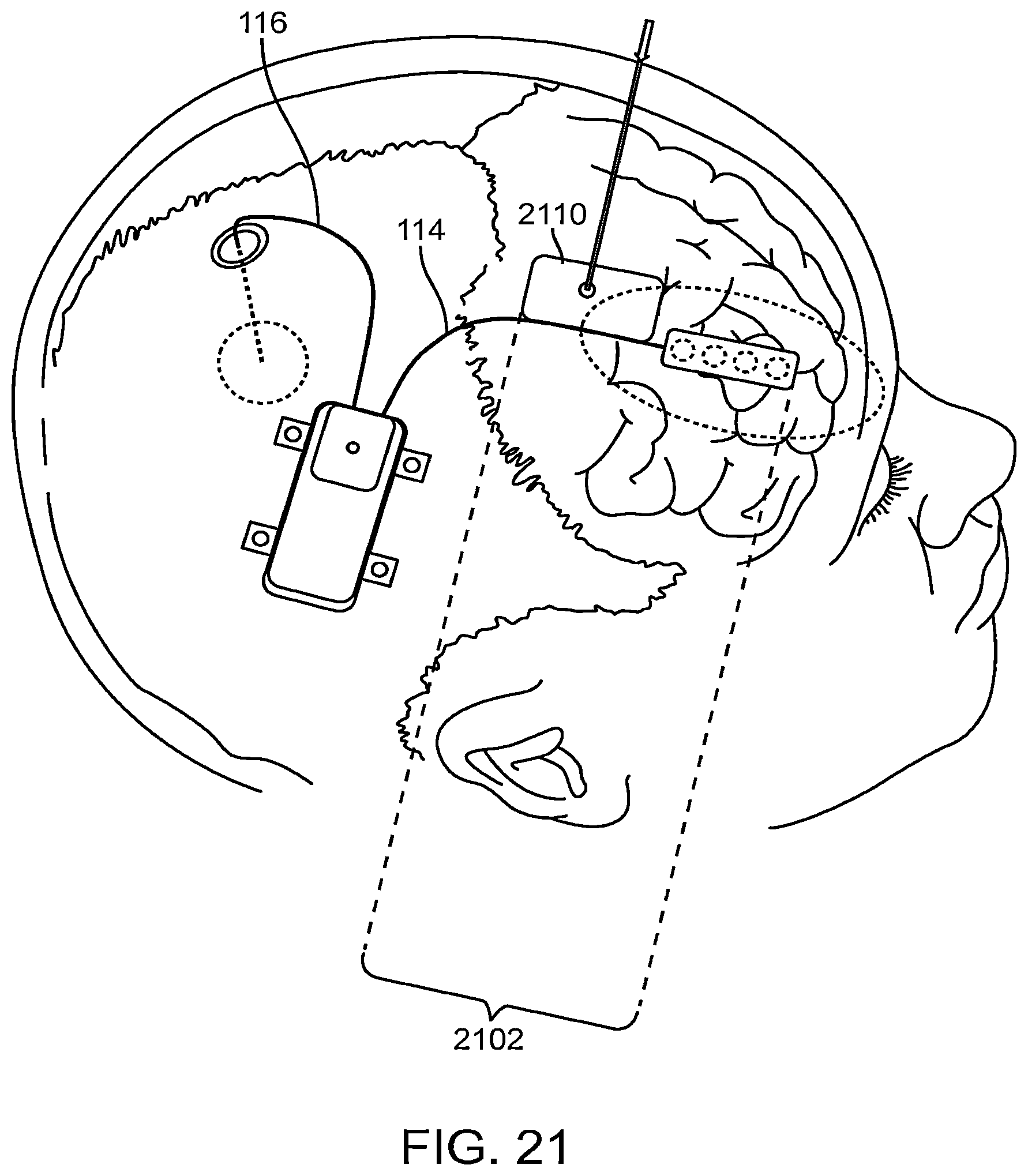 Patent US12496011 Figure 20 – Systems and methods for assessing the effectiveness of a therapy including a drug regimen using an implantable medical device