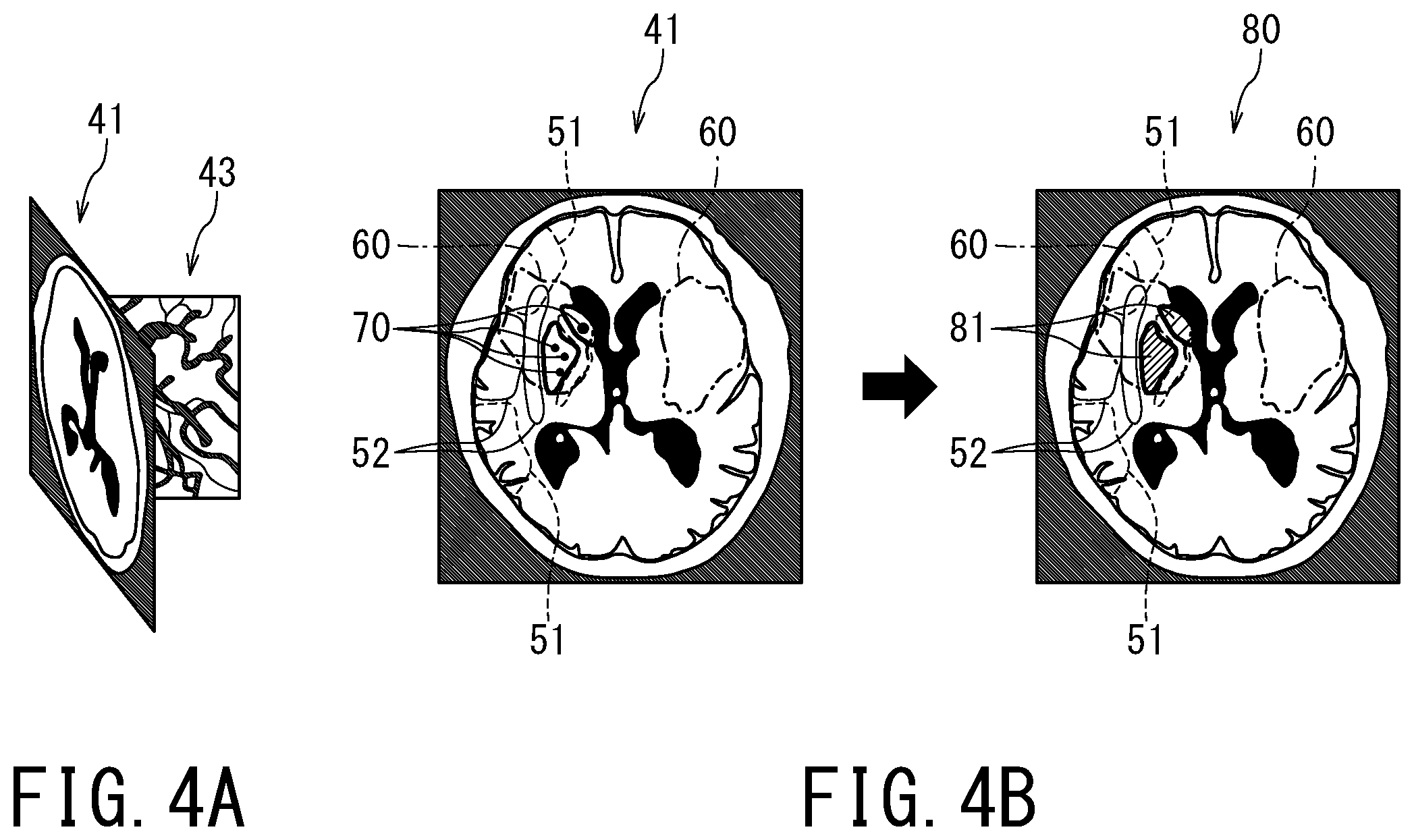 Patent US12496029 Figure 3 – Medical image processing apparatus, X-ray diagnostic apparatus, and storage medium
